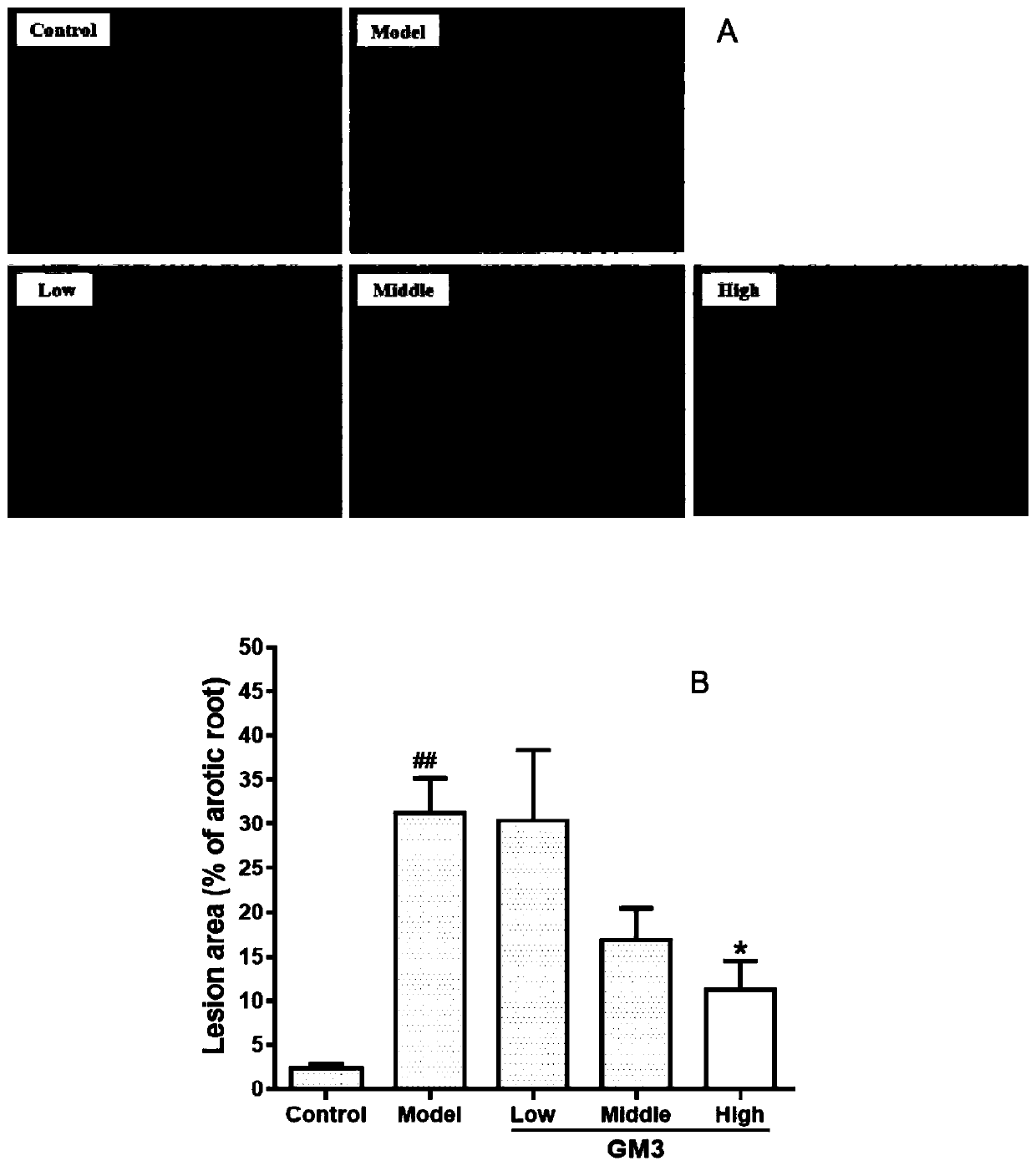 Application of ganglioside GM3 in preparation of medicine for treating atherosclerosis