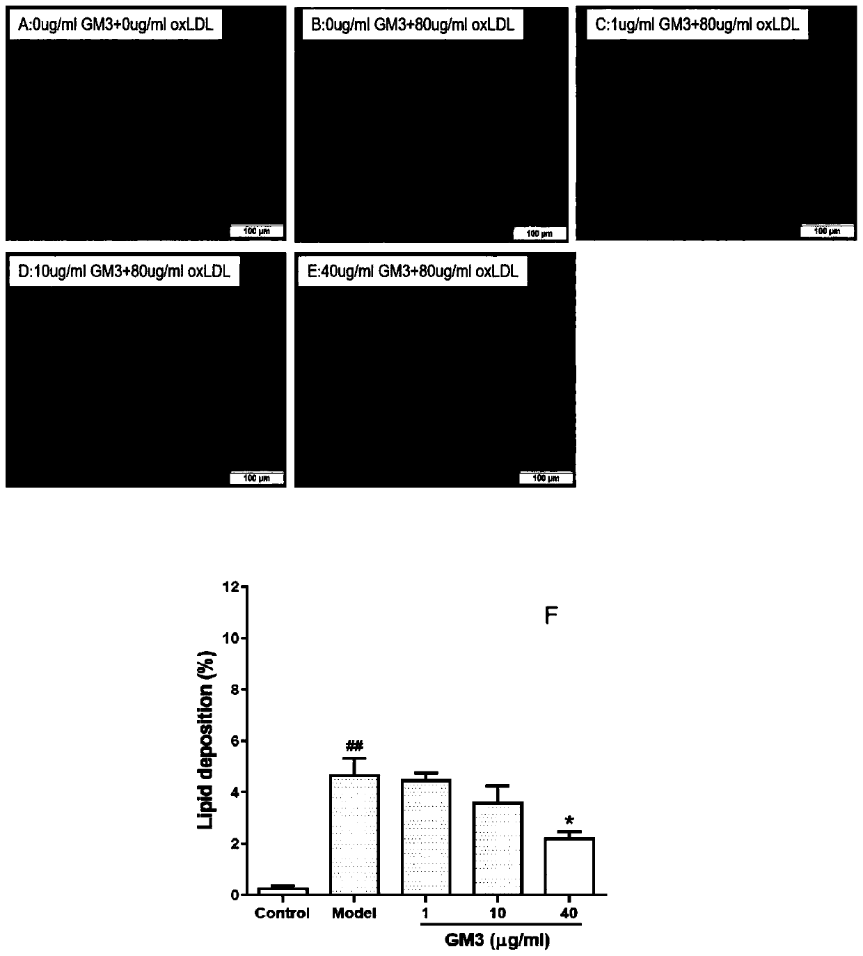 Application of ganglioside GM3 in preparation of medicine for treating atherosclerosis