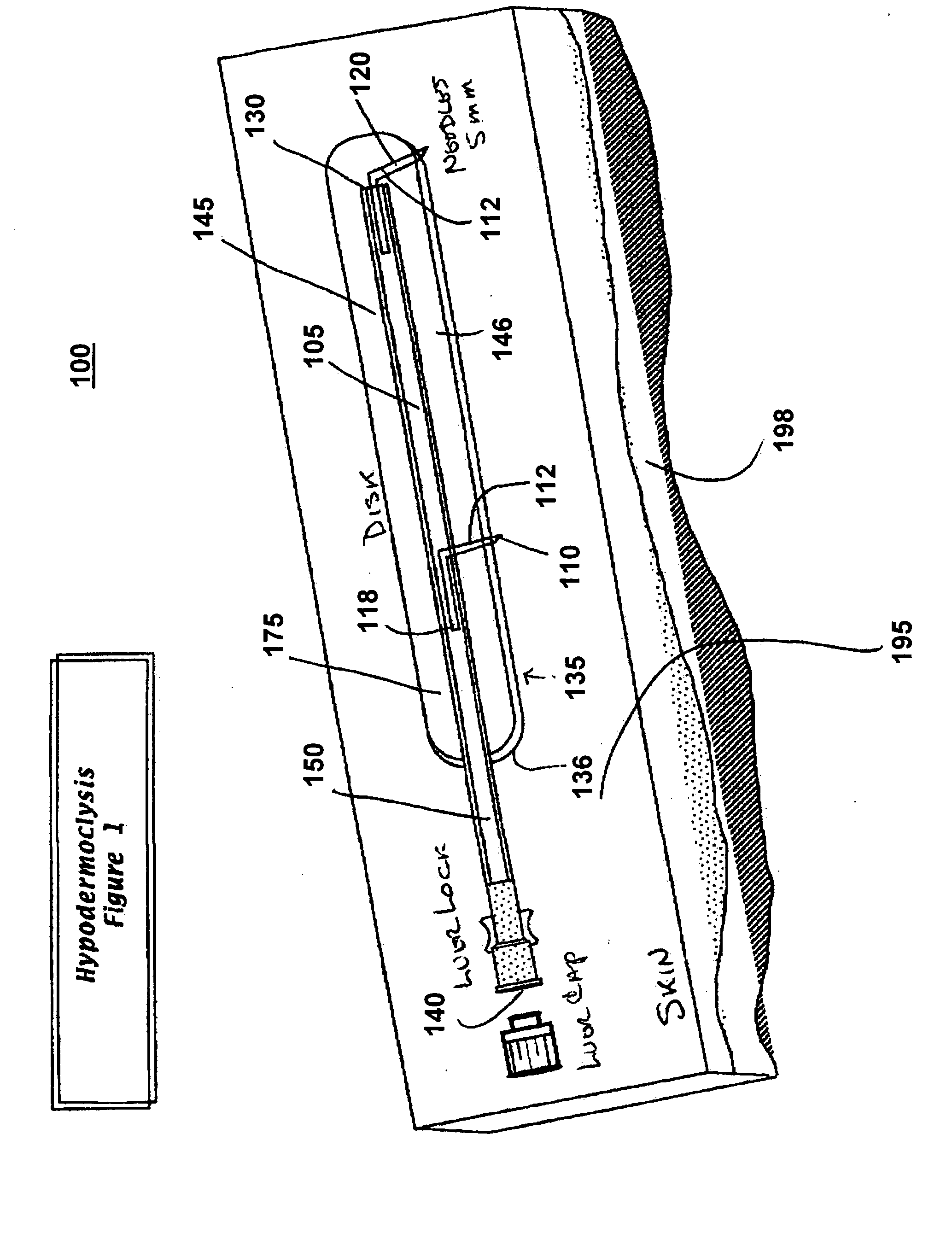Device for subcutaneous infusion of fluids
