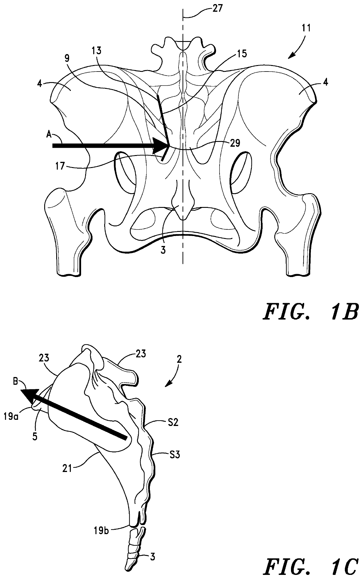 Systems for Sacroiliac Joint Stabilization