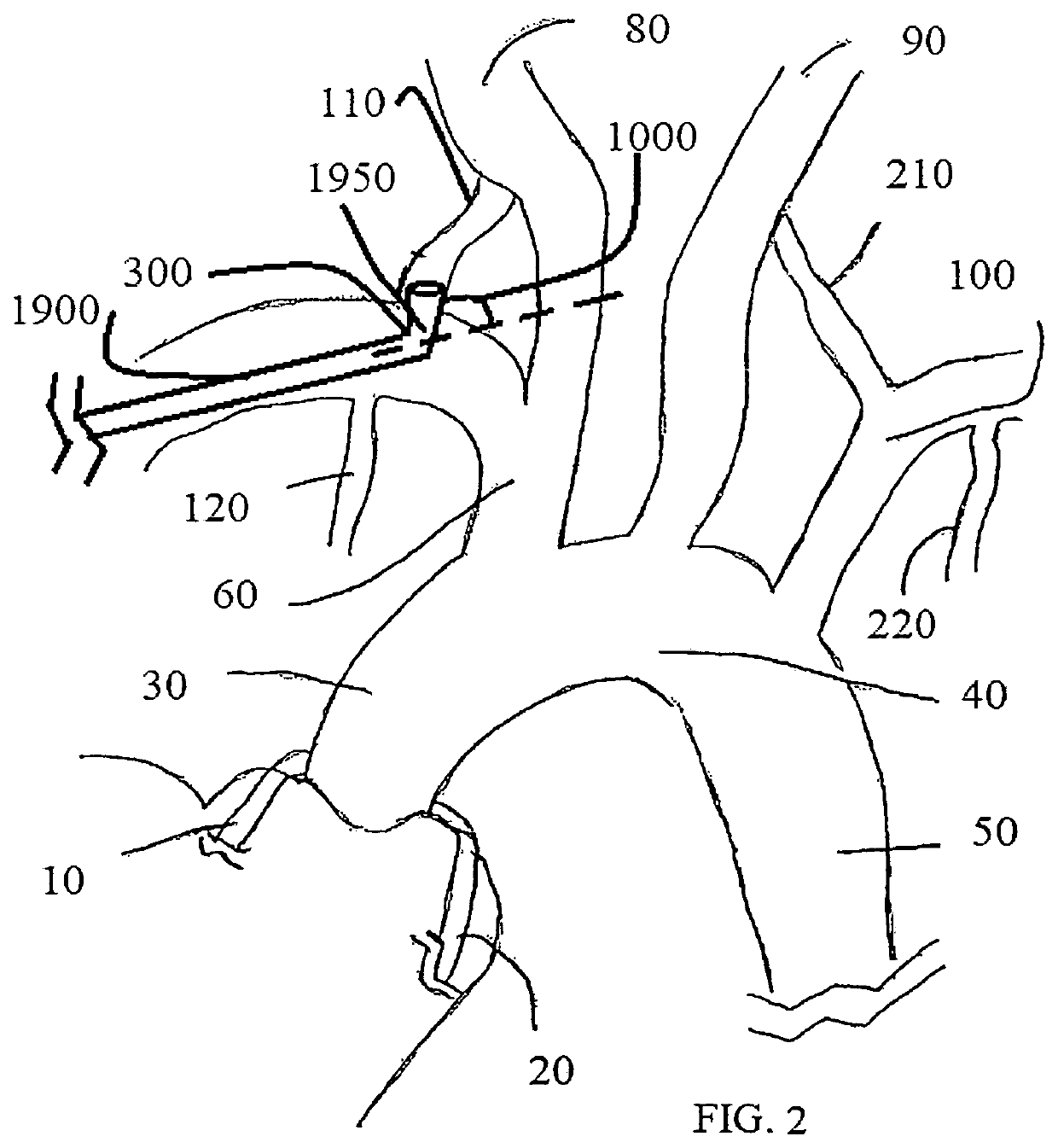 Trans-radial access endovascular catheter and method of use