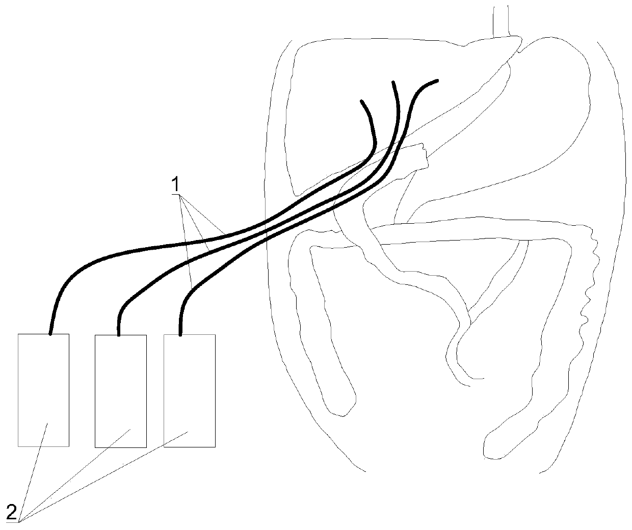 Novel biliary and intestinal anastomosis stent drainage device