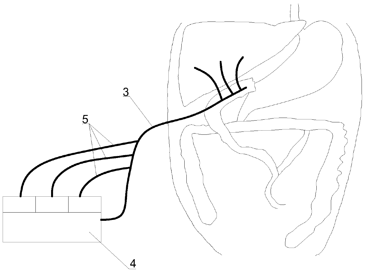 Novel biliary and intestinal anastomosis stent drainage device