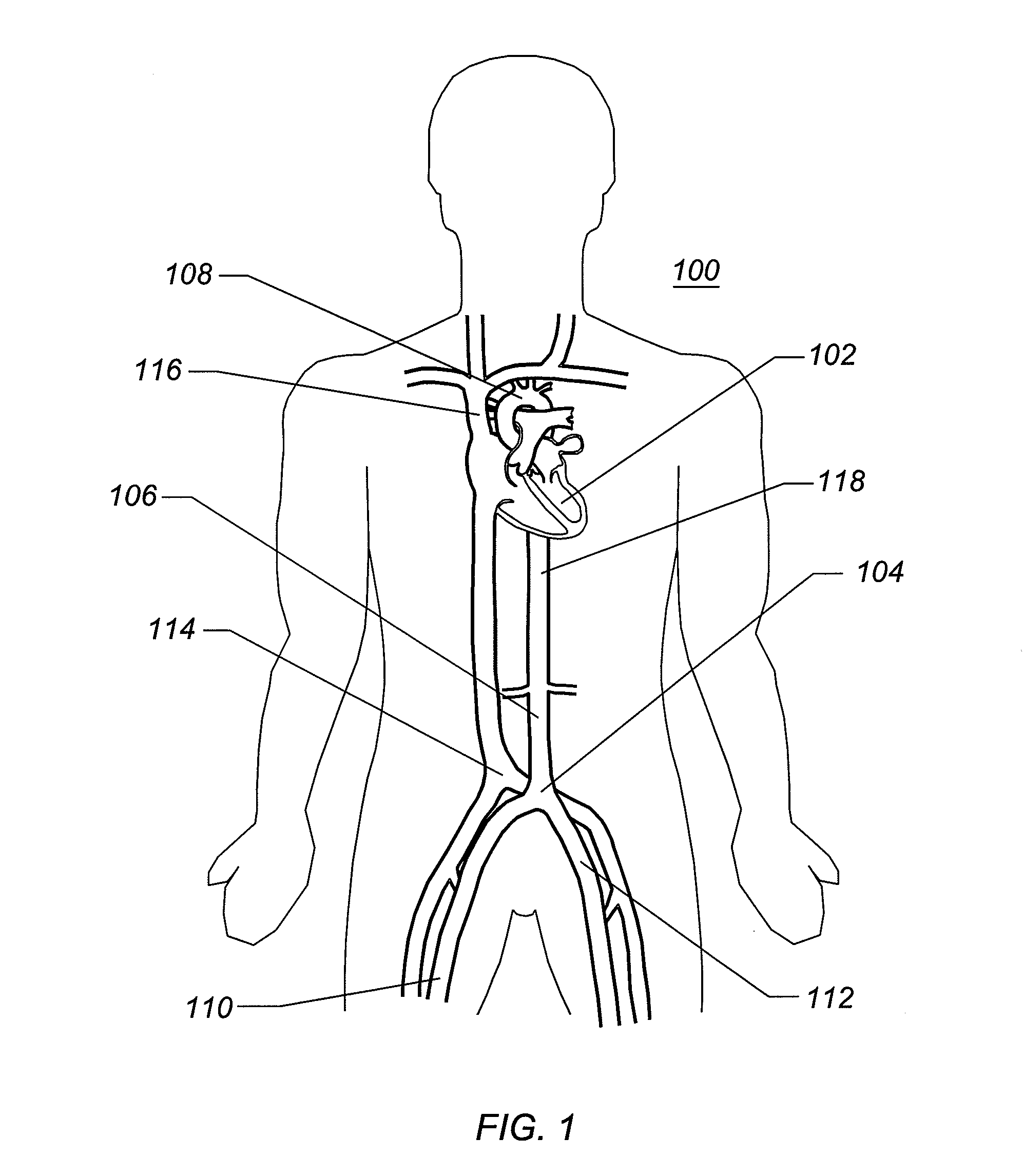 Expandable iliac sheath and method of use