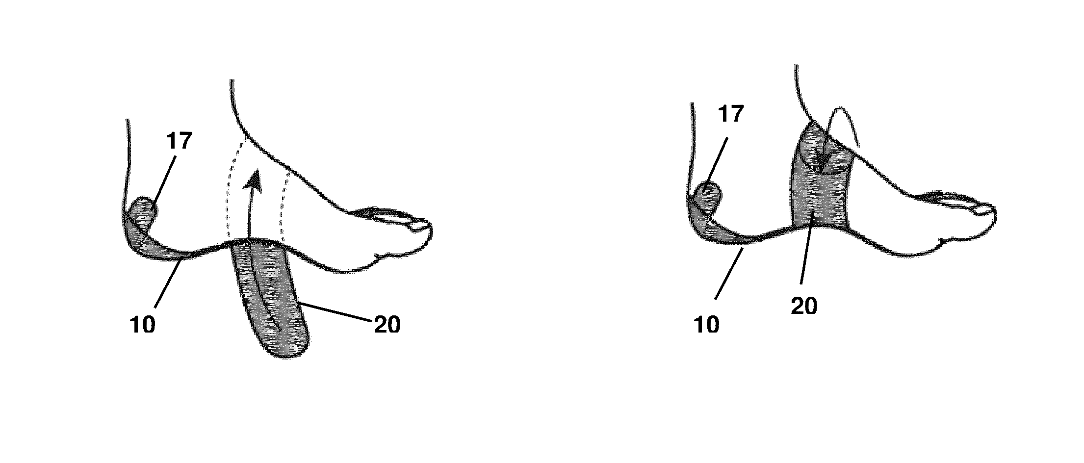 Disposable Two-Part Orthotic Foot Support Strap System And Method