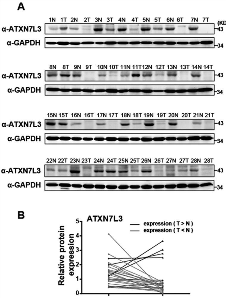 Application of ATXN7L3 in liver cancer diagnosis, treatment and prognosis