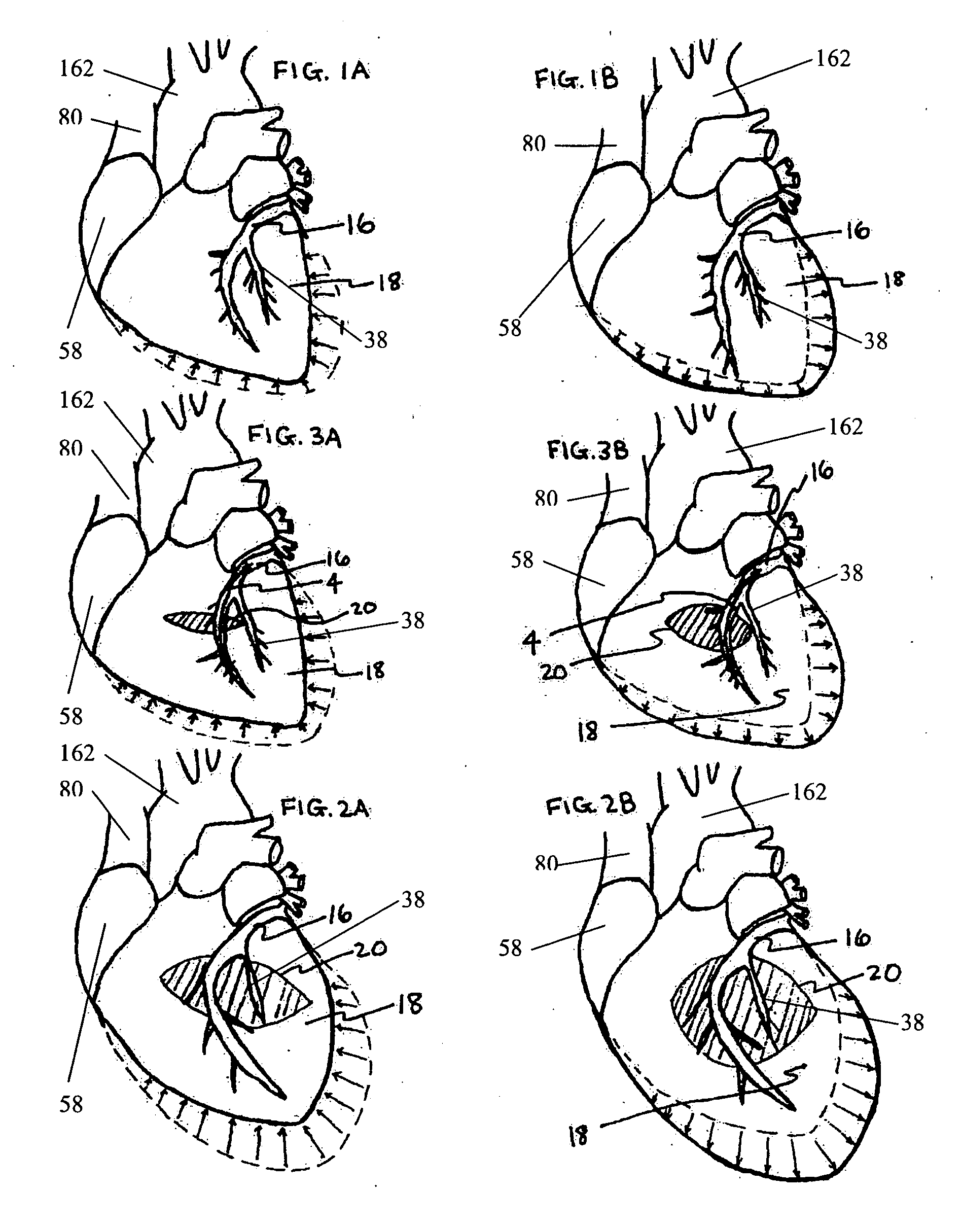 Systems for heart treatment