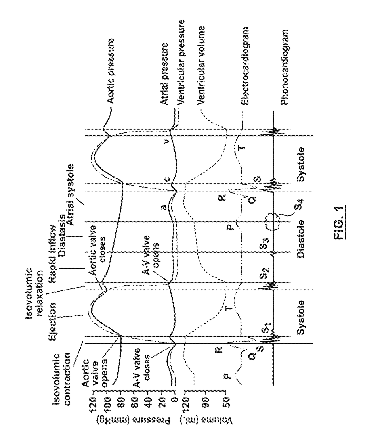 Cardiac monitor system and method for home and telemedicine application