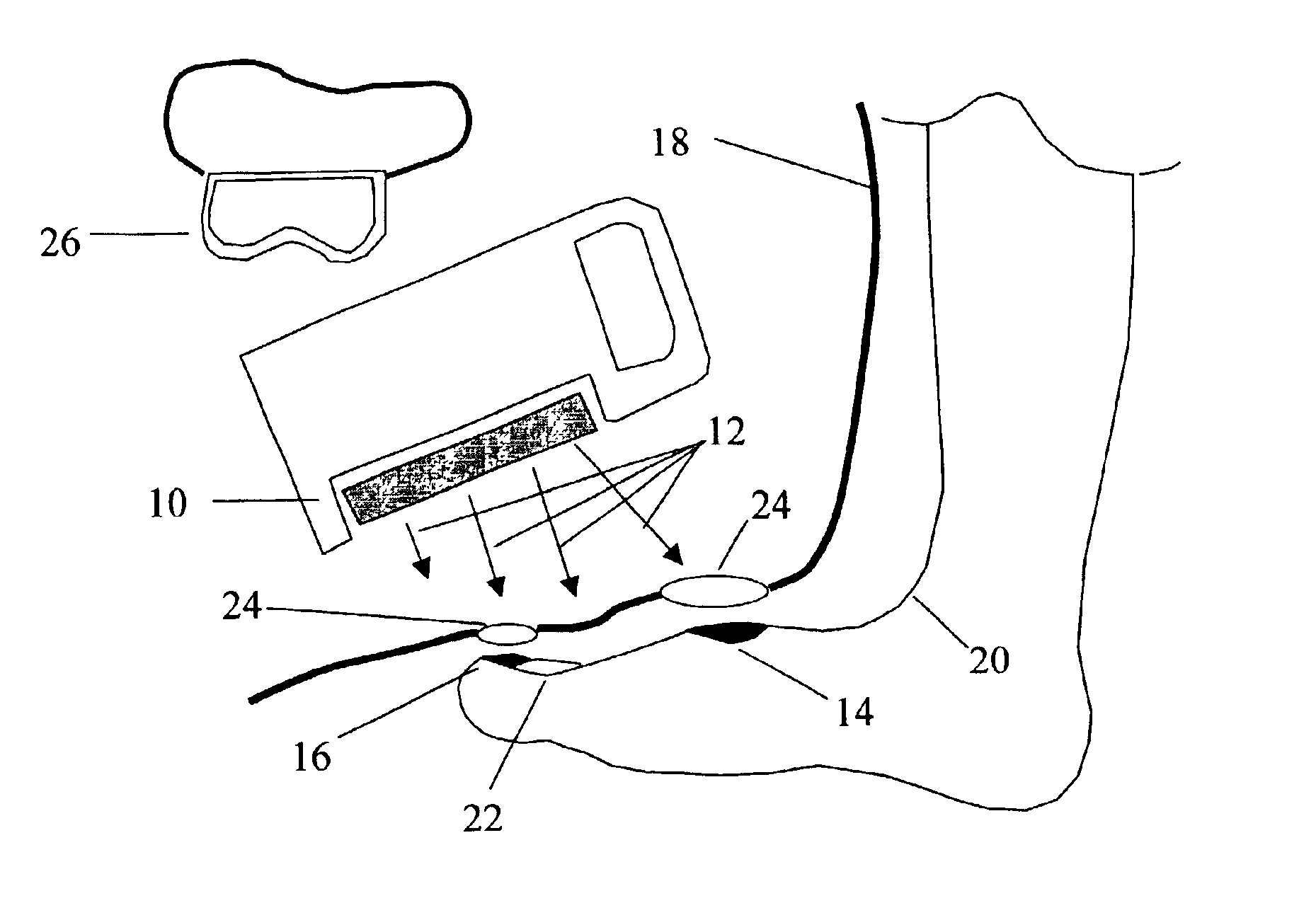 Method for the prevention and treatment of skin and nail infections