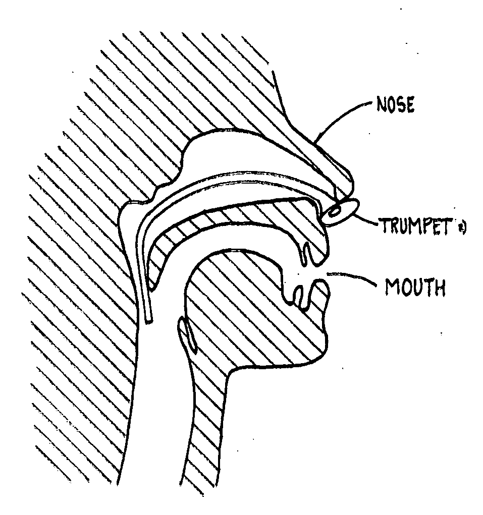 Nasopharyngeal Trumpet with Inflatable Tip