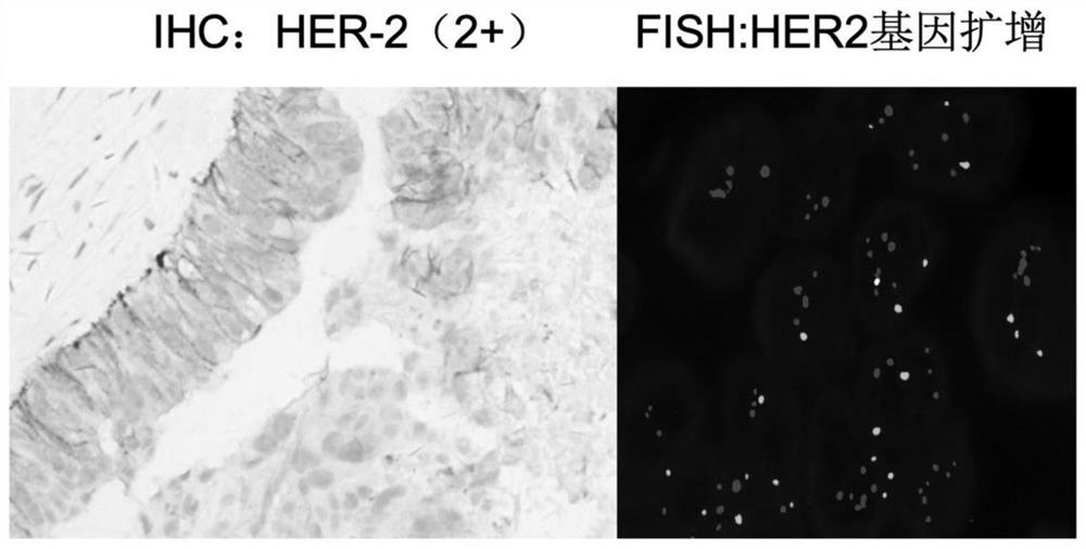 HER2 positive gastric cancer drug-resistant PDX model as well as construction method and application thereof