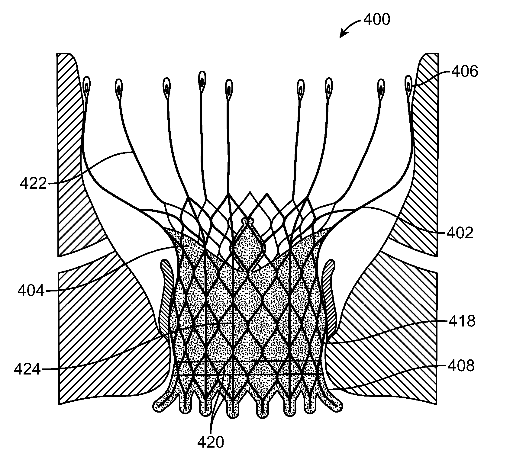 Prosthetic Valve With Device for Restricting Expansion