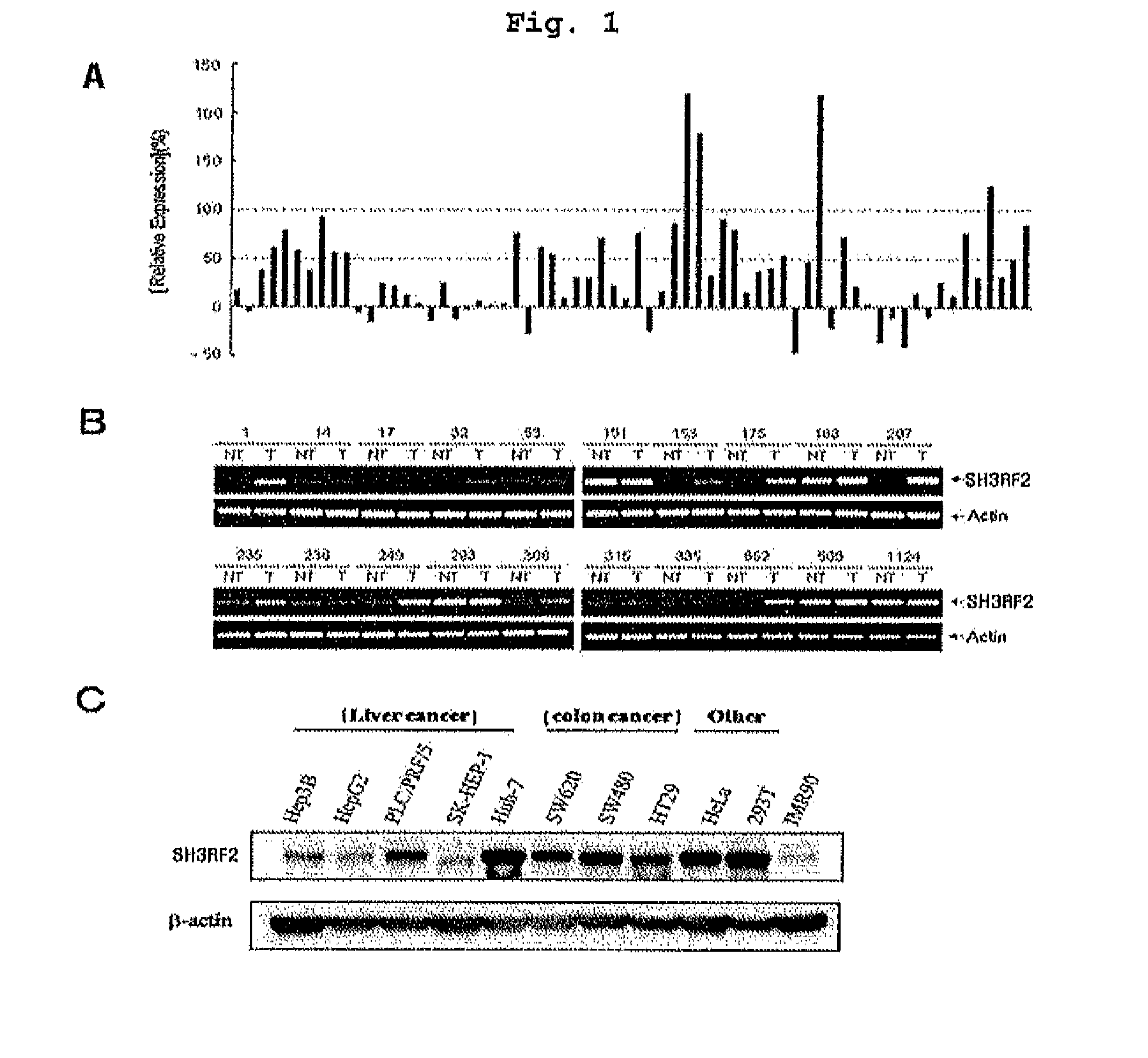 Composition containing inhibitors of the expression or activity of SH3RF2 for preventing or treating cancer