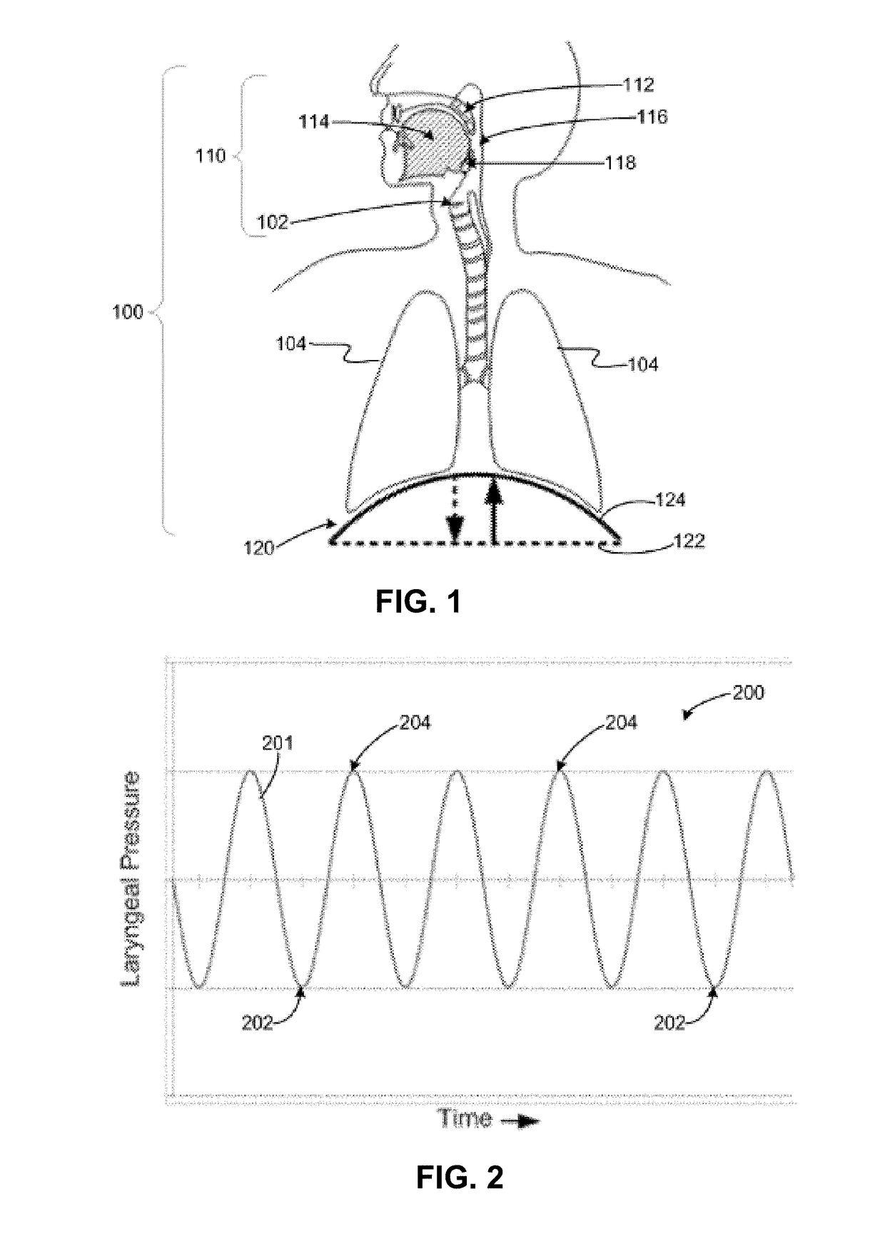 Neural monitoring methods and systems for treating upper airway disorders
