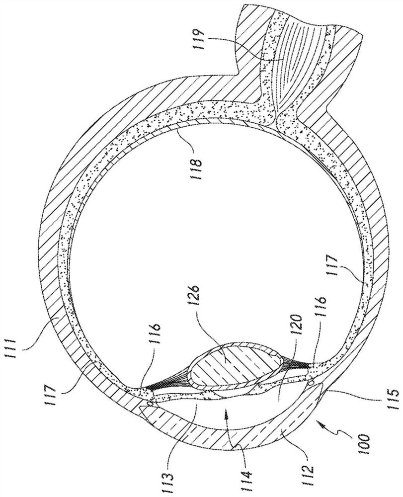 Systems and methods for delivering multiple ocular implants