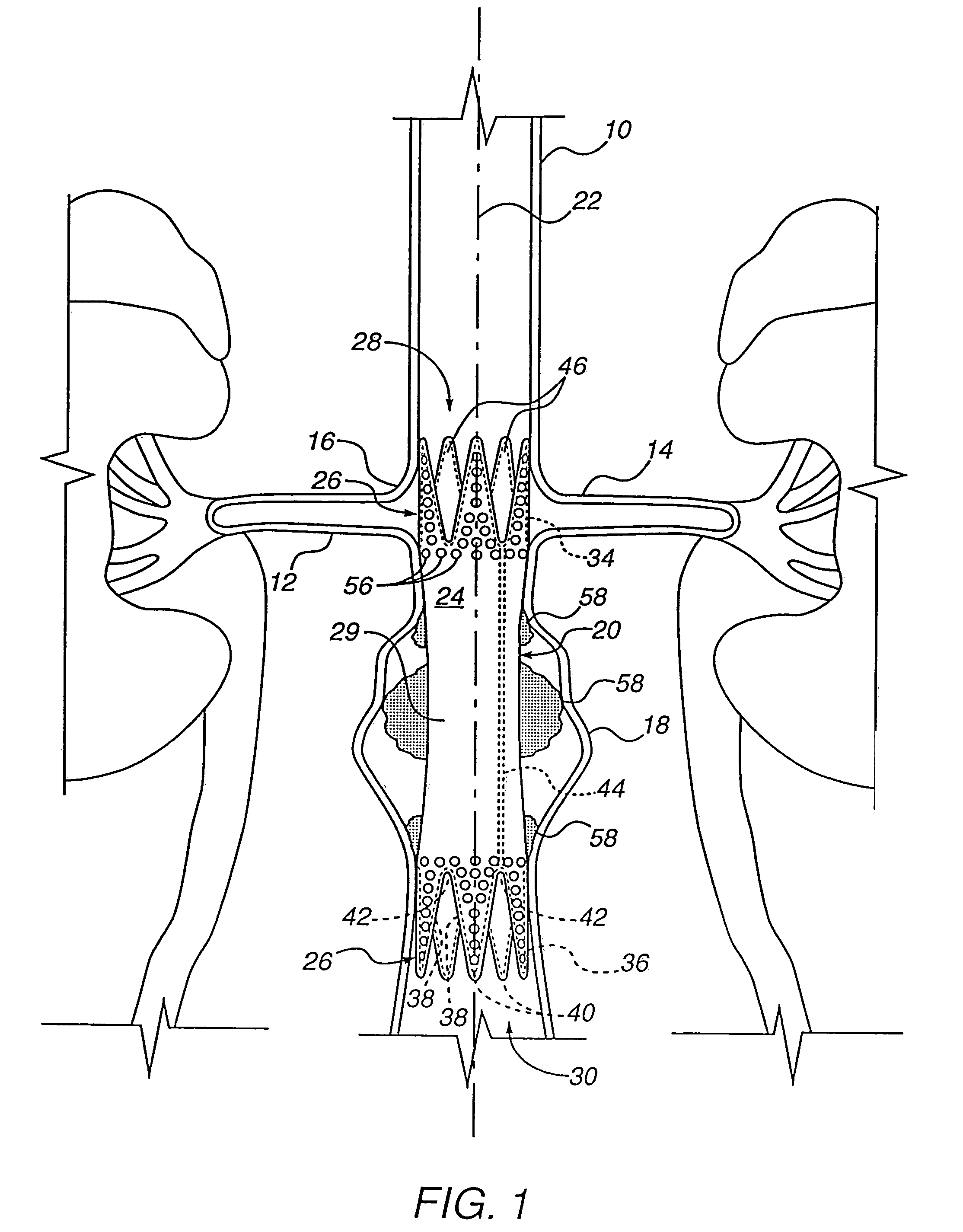 Apparatus for engrafting a blood vessel
