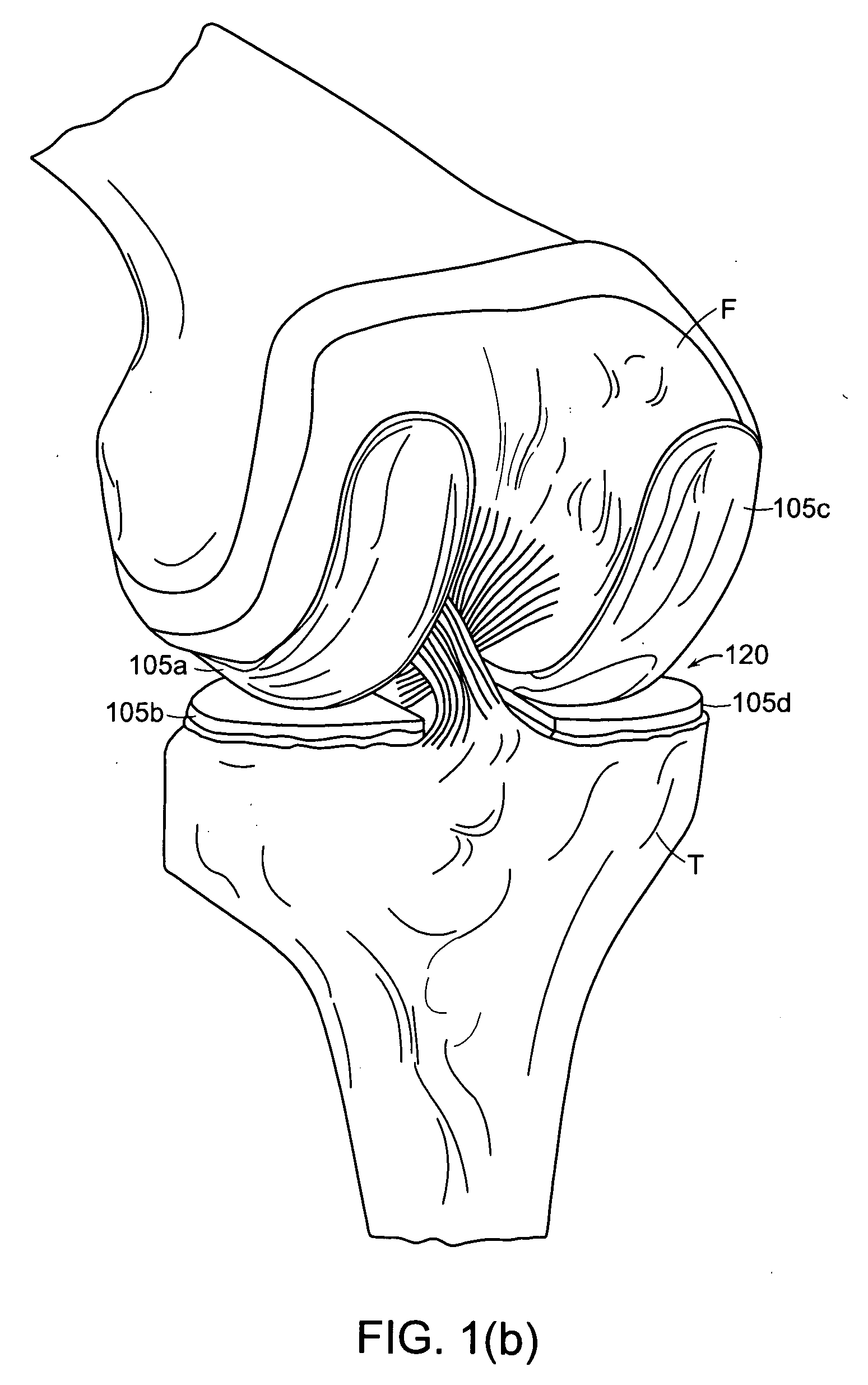 Implant planning using corrected captured joint motion information