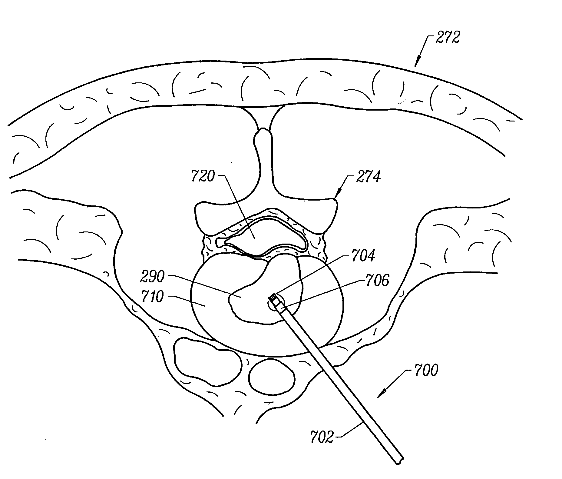 Systems and methods for electrosurgical prevention of disc herniations