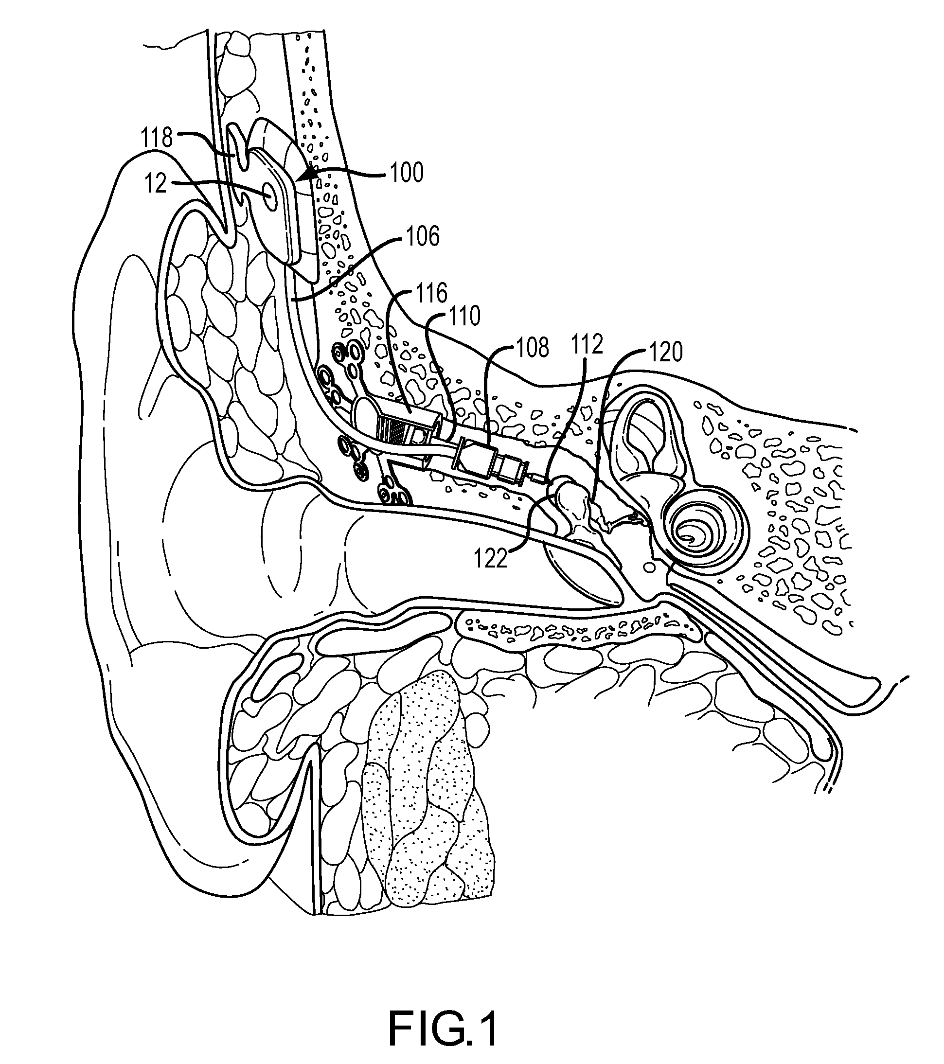 Dual feedback control system for implantable hearing instrument