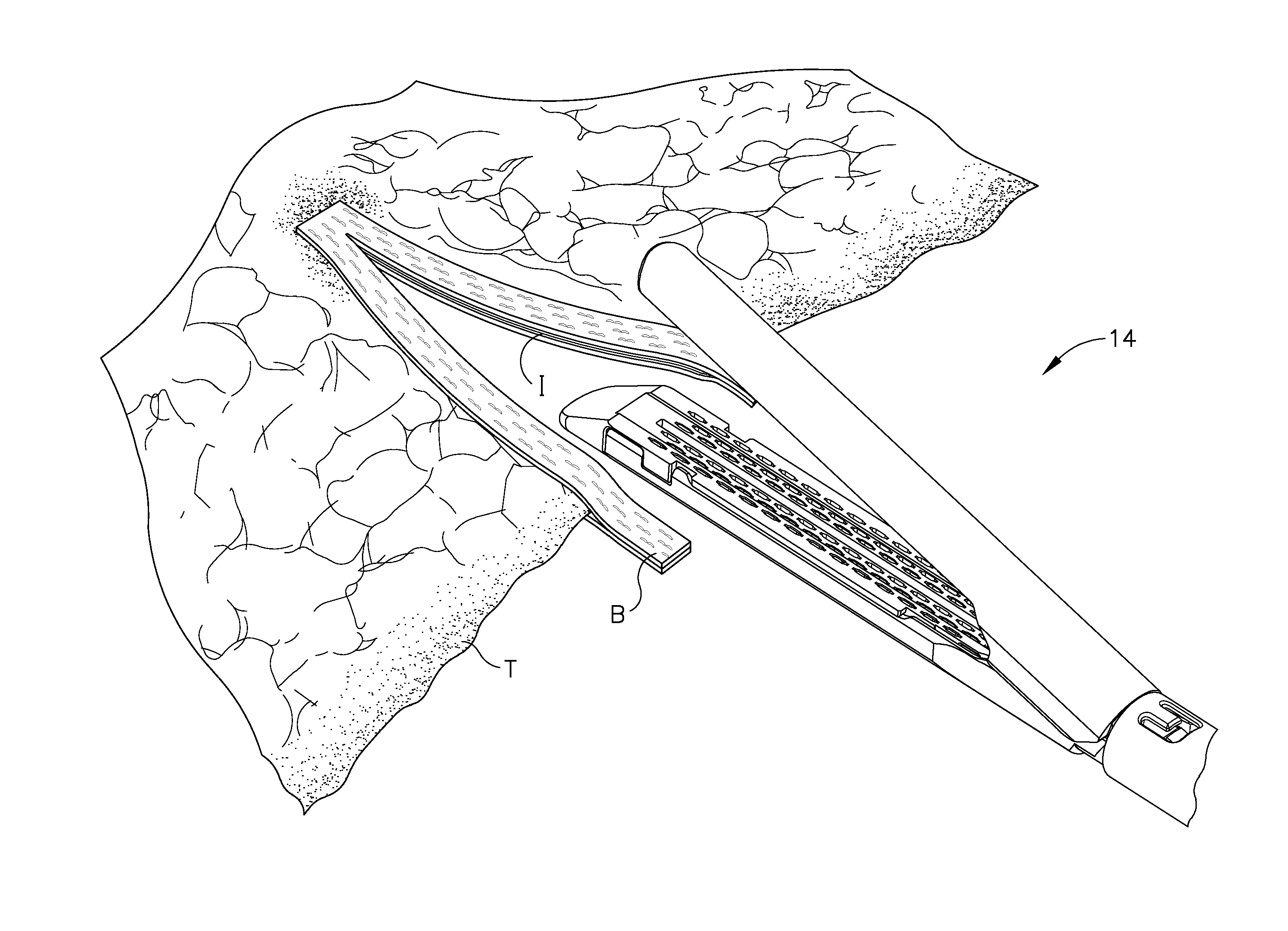 Buttress material with alignment and retention features for use with surgical end effectors