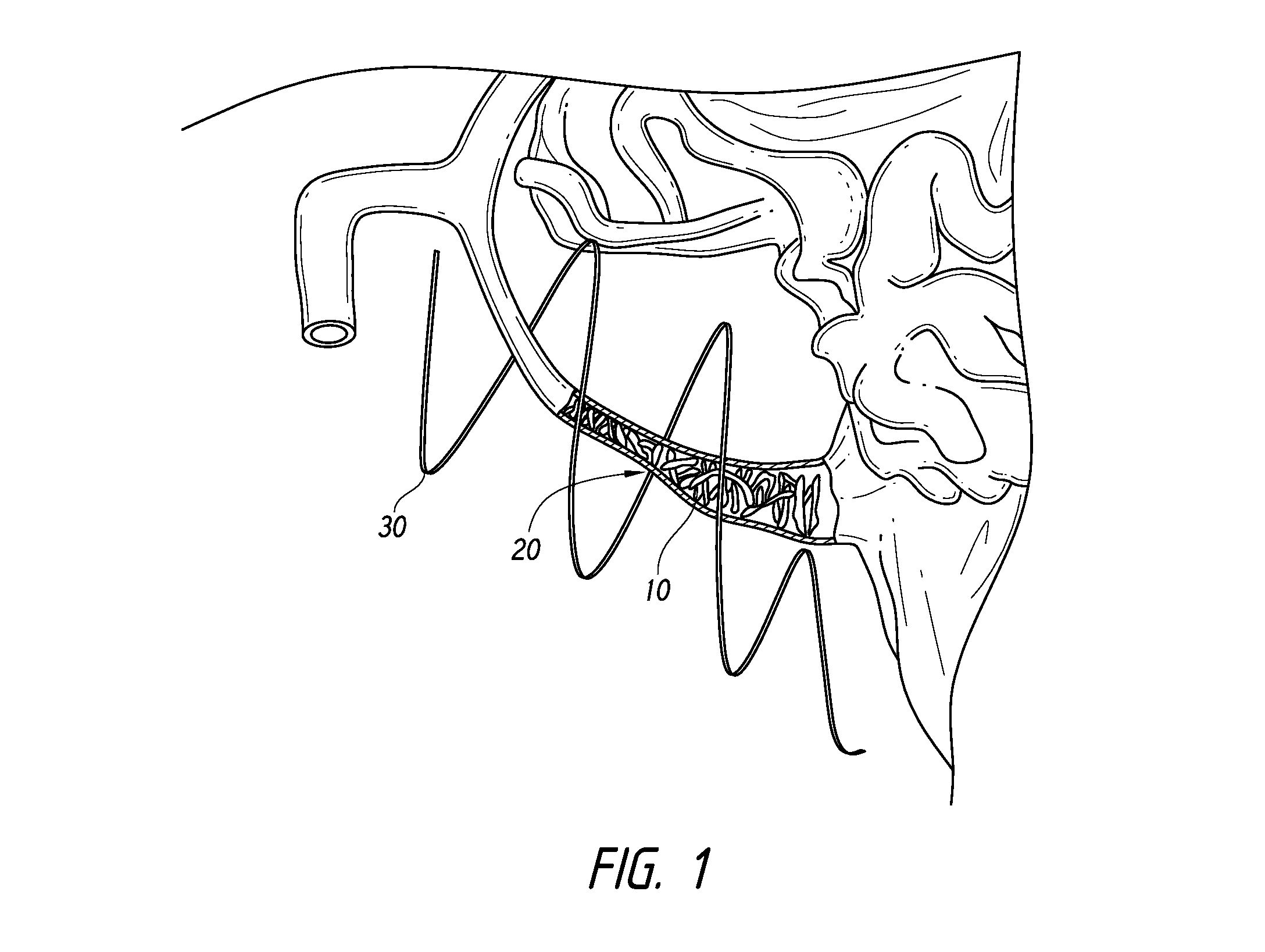 Methods and apparatuses for blood vessel occlusion