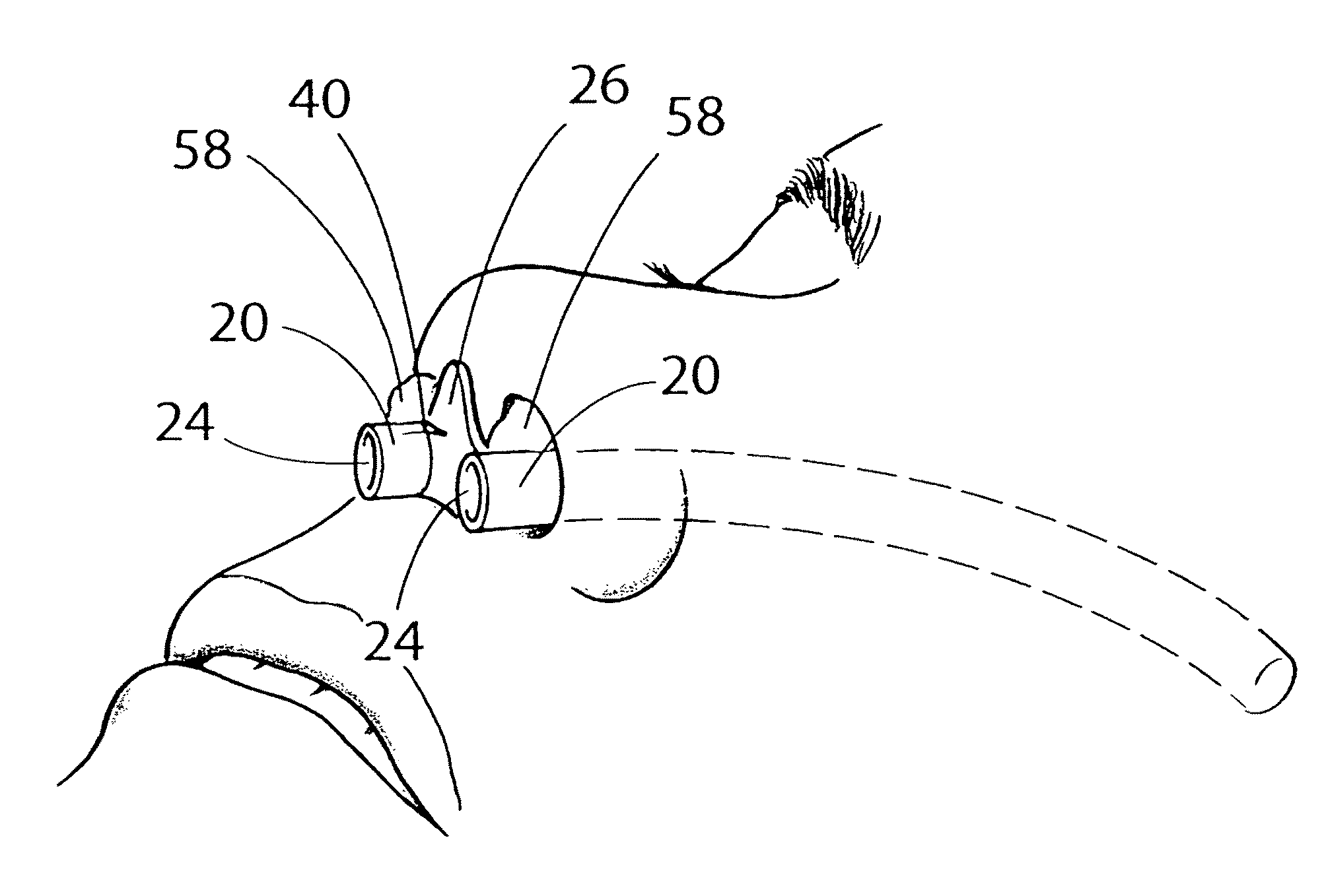 Device and method for maintaining unobstructed nasal passageways after nasal surgery