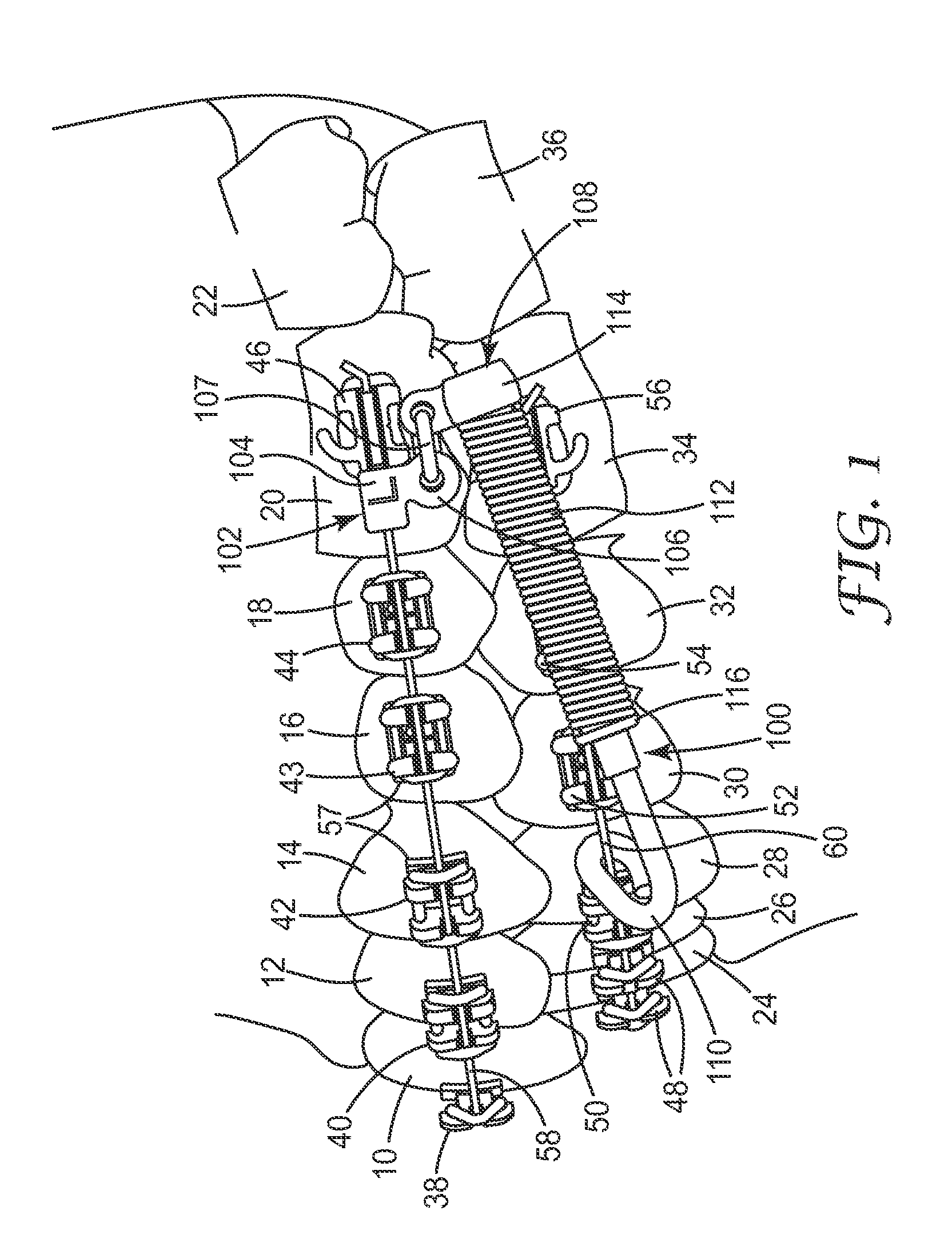 Orthodontic connector providing controlled engagement with an orthodontic wire