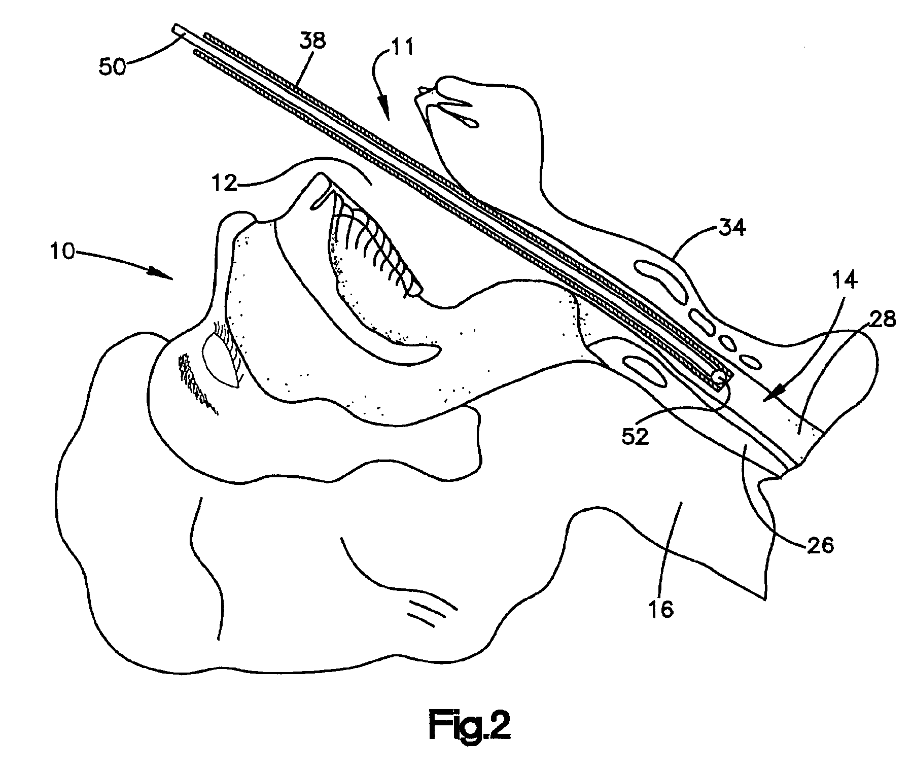 Medicant delivery system and method