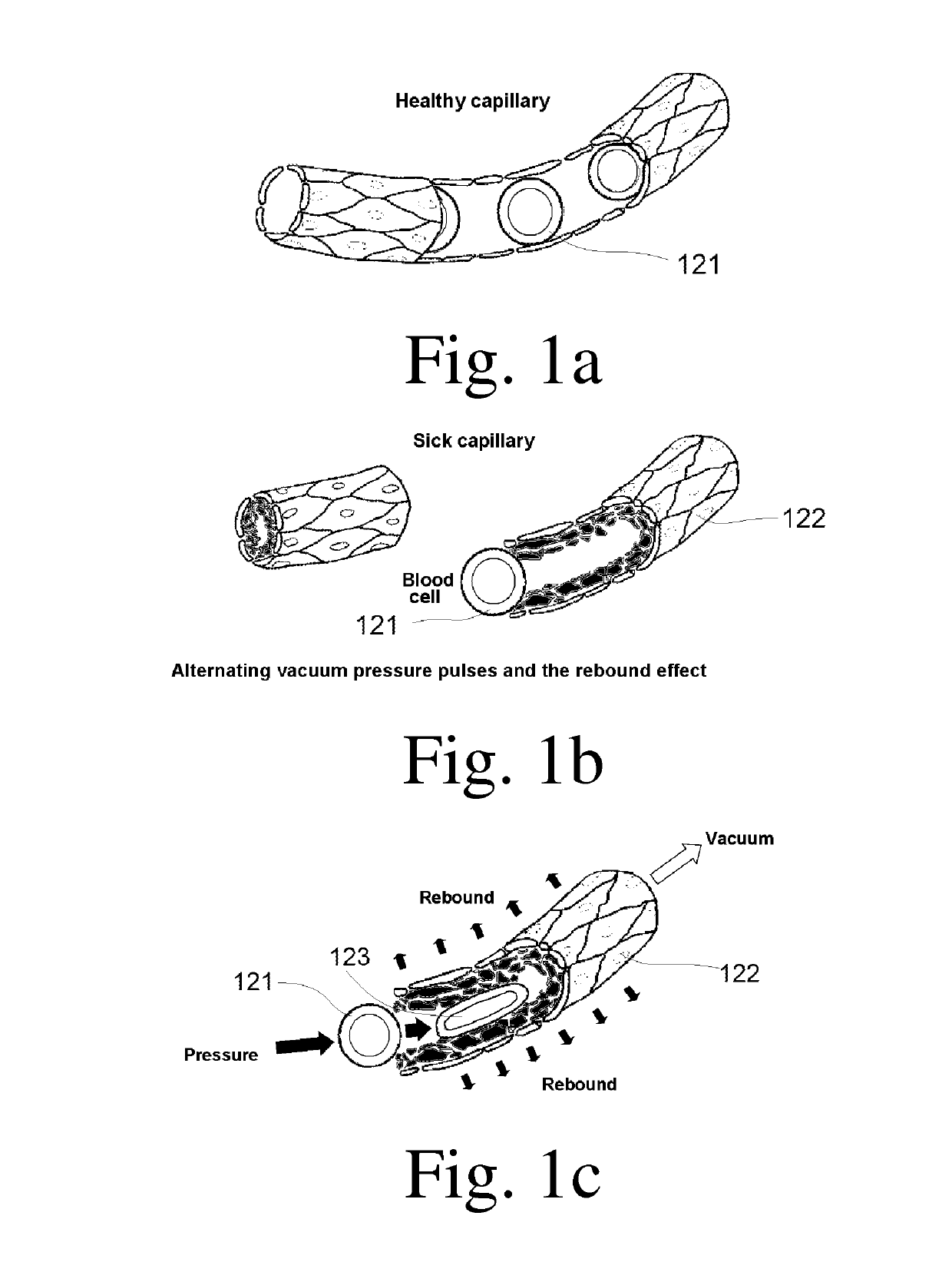 Devices for functional revascularization by alternating pressure