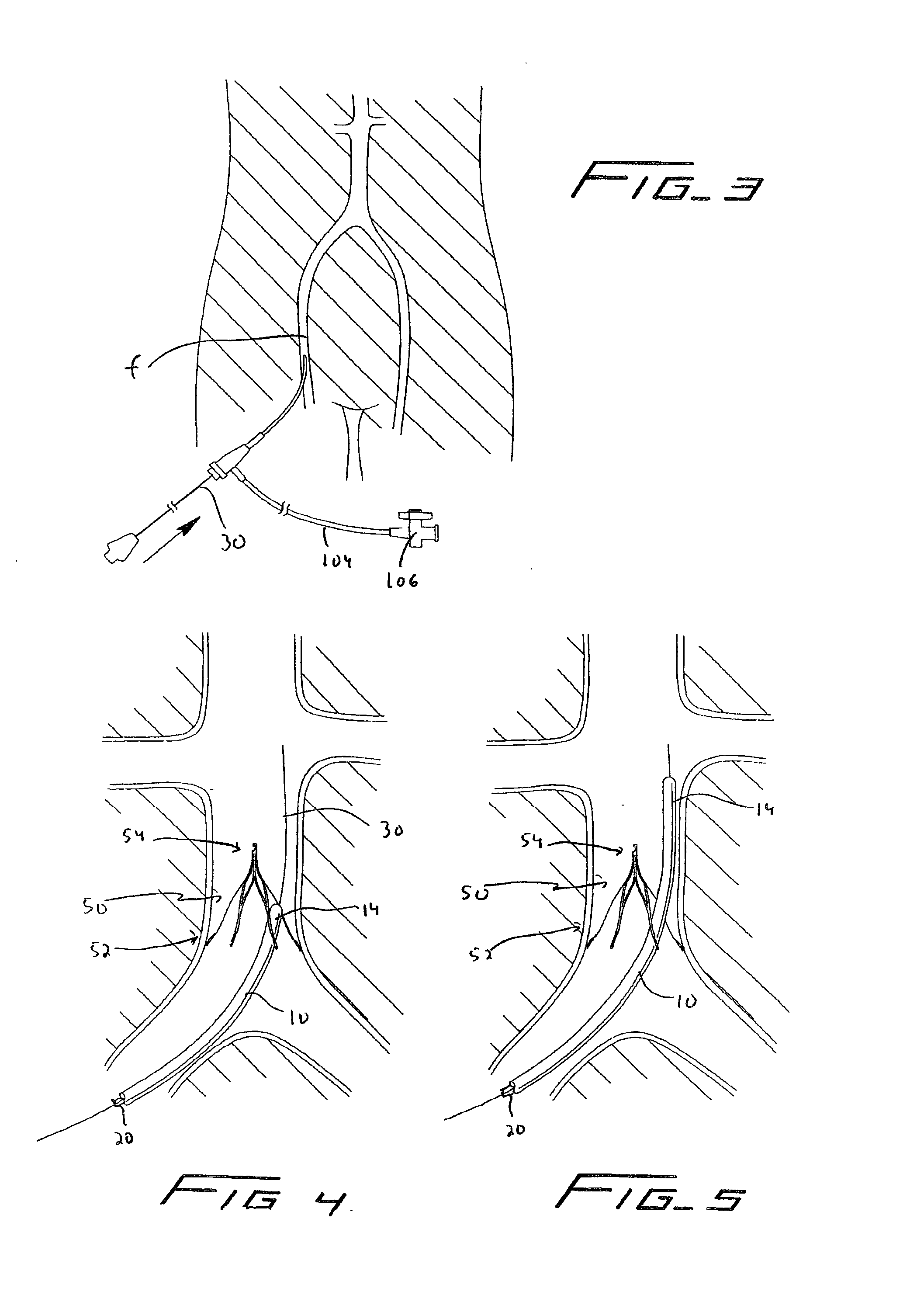 Method of removing a vein filter