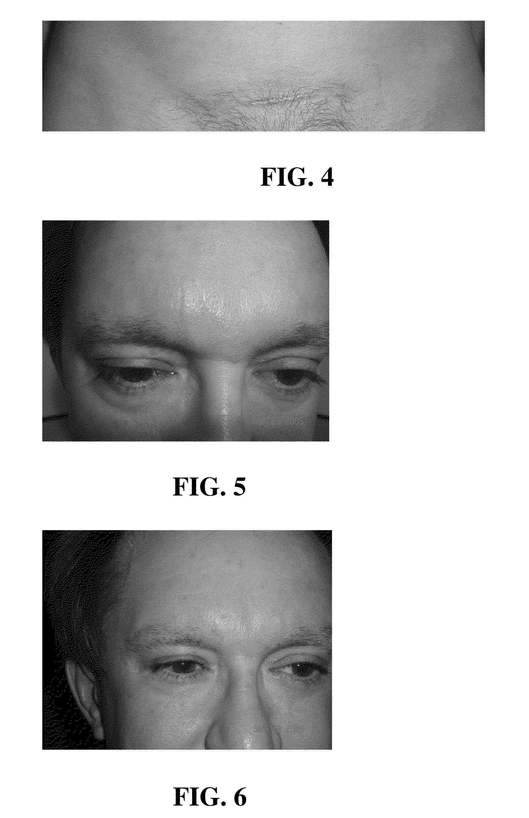 Compositions and methods for treatment of dermal scarring and wrinkling