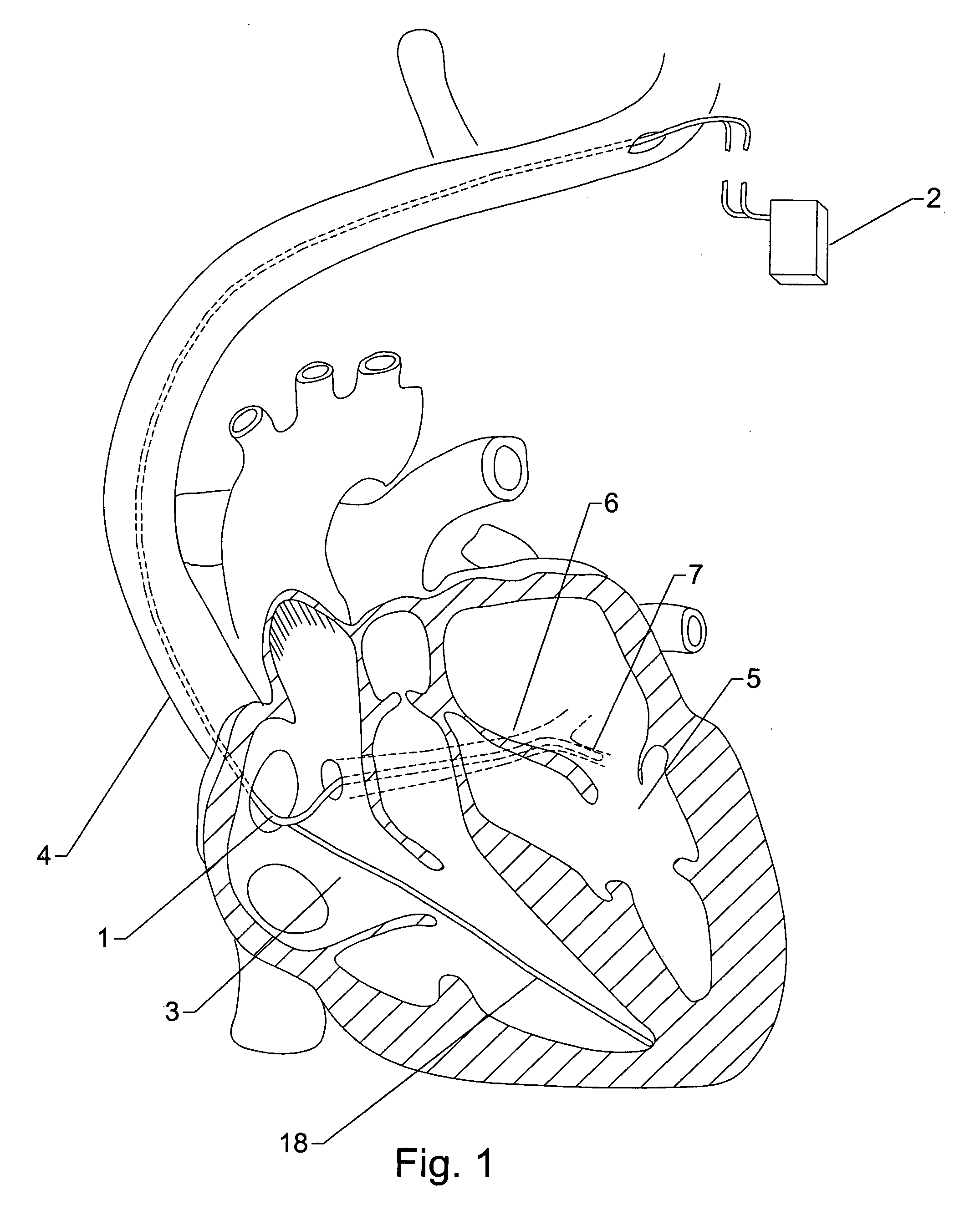 Method and apparatus for adjusting interventricular delay based on ventricular pressure
