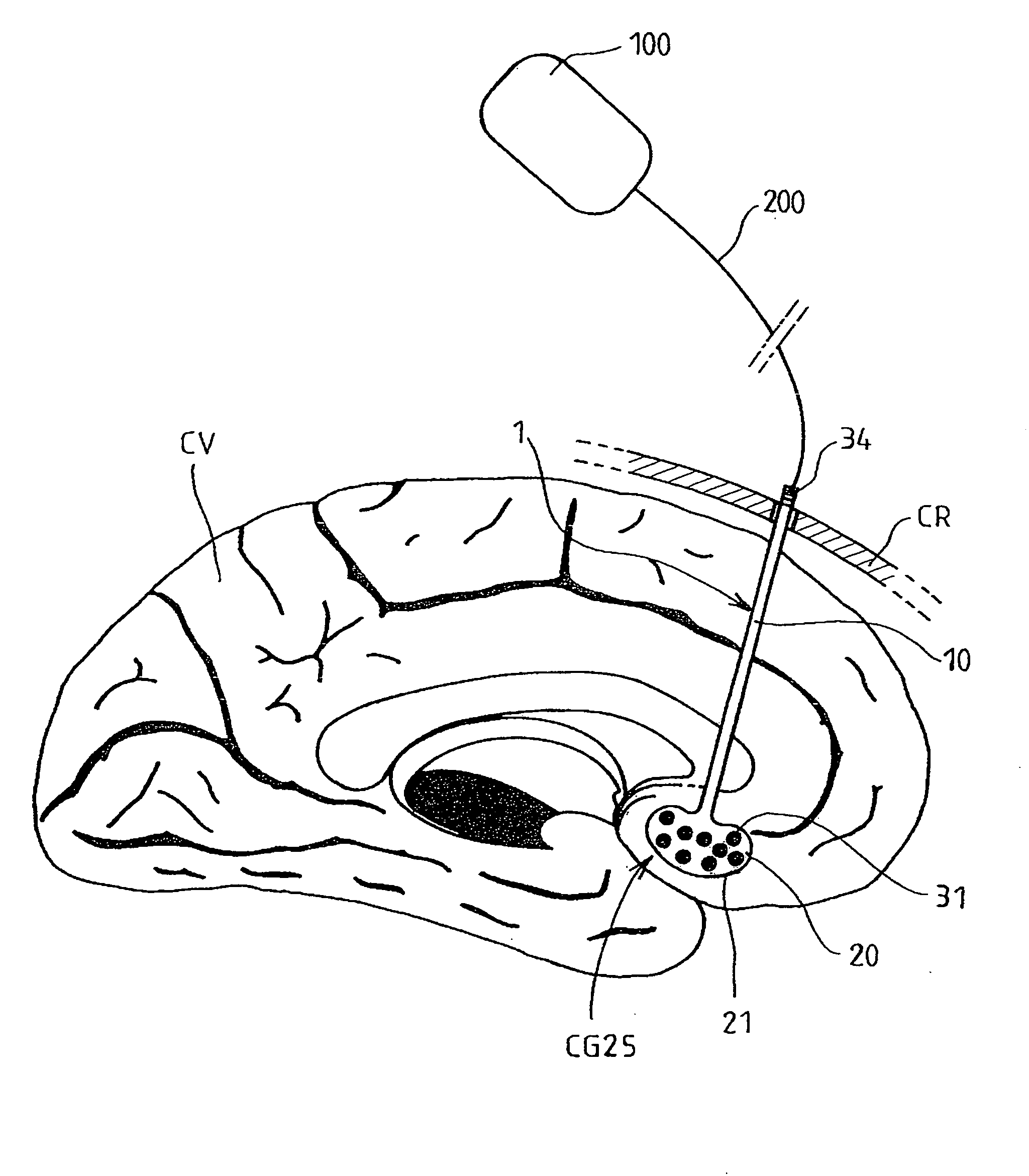 Multiple electrode lead and a system for deep electrical neurostimulation including such a lead