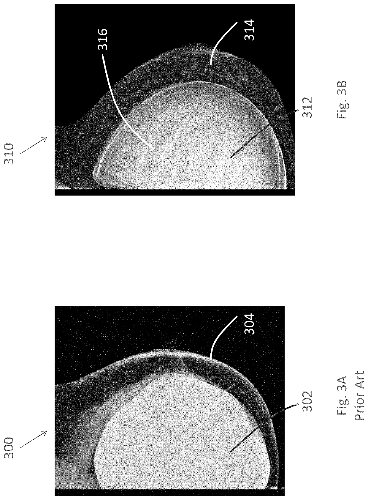 Composite implant material