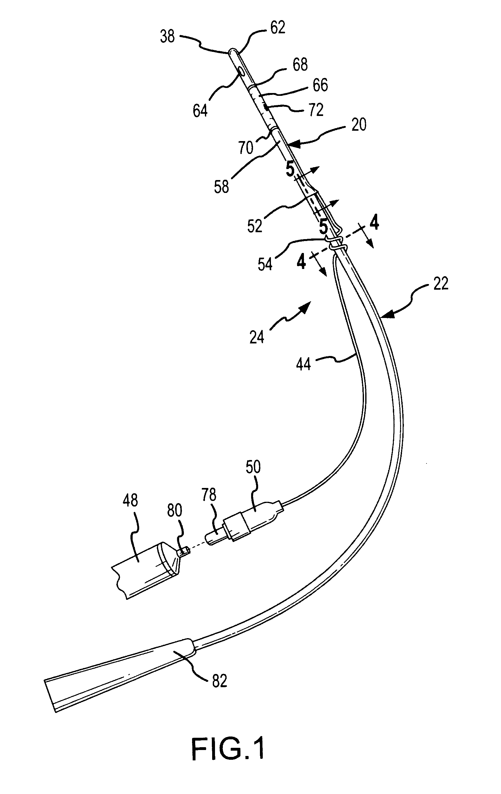 Partial-length, indwelling prostatic catheter using coiled inflation tube as an anchor and methods of draining urine and flushing clots