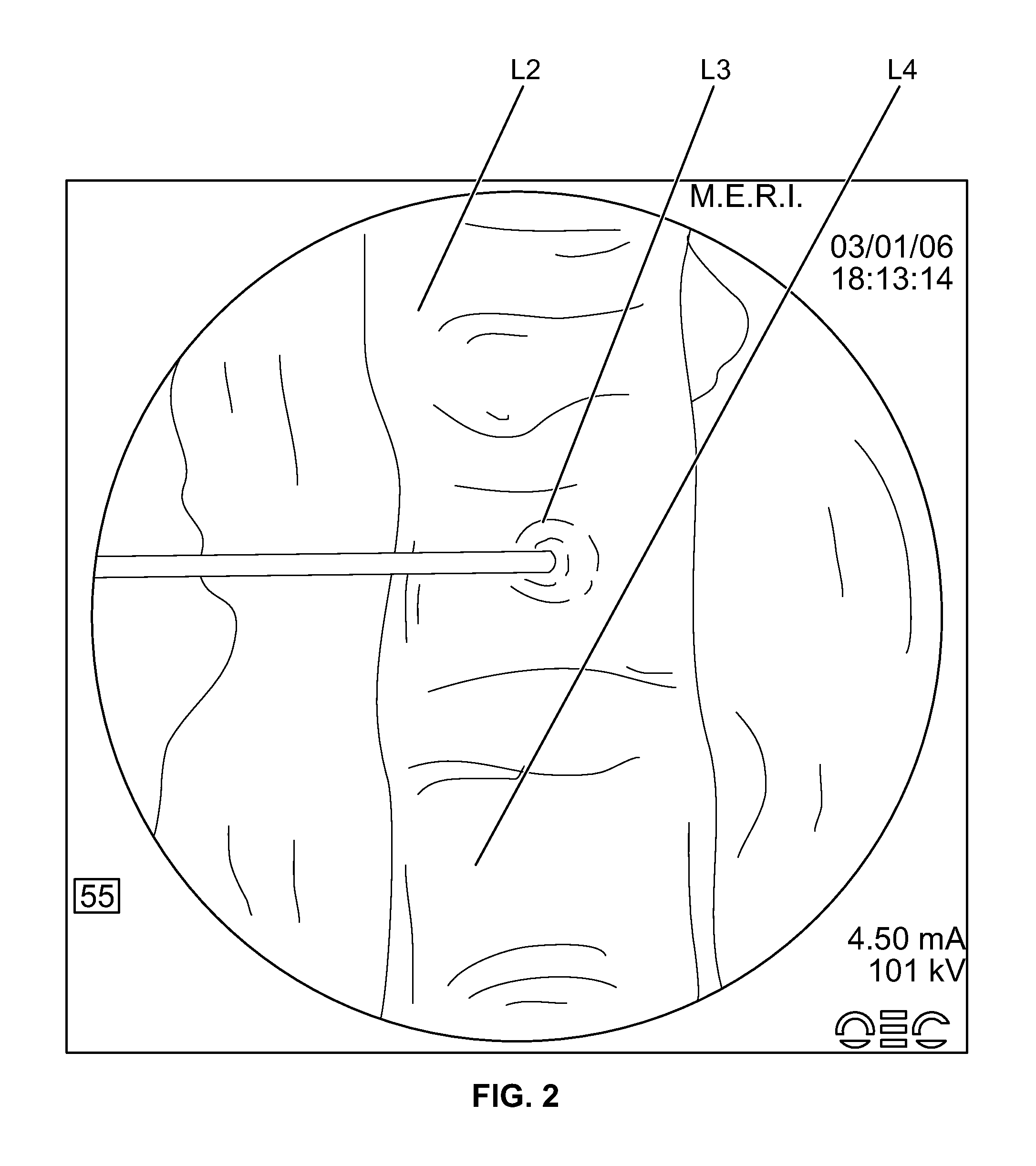 Compositions and methods for treating the vertebral column