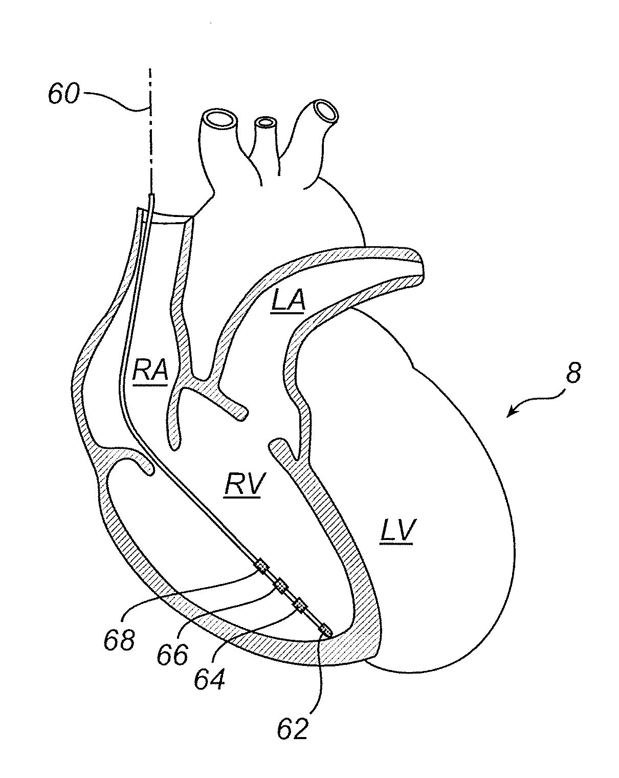 Heart failure detector