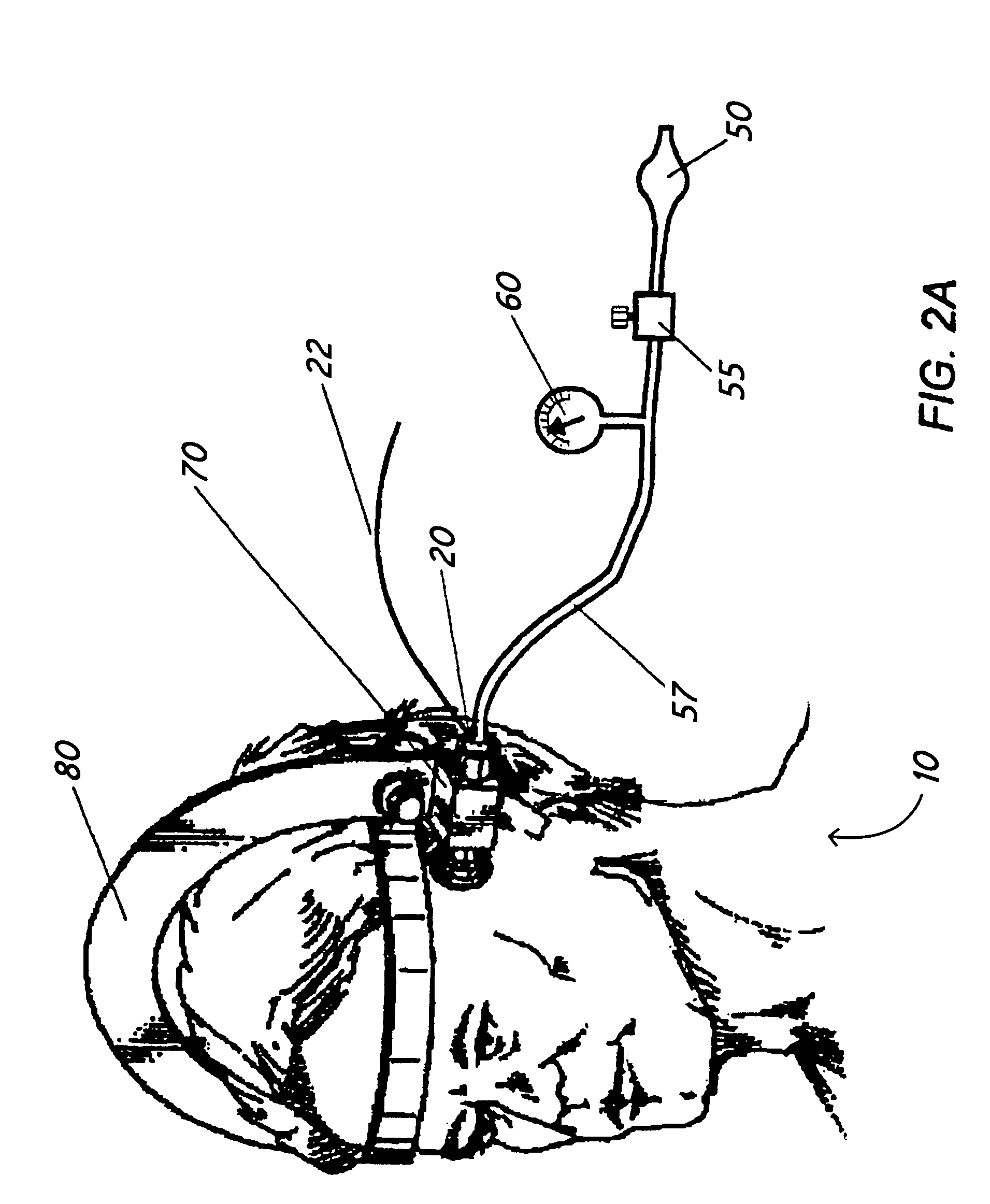 Method and apparatus for noninvasive determination of the absolute value of intracranial pressure