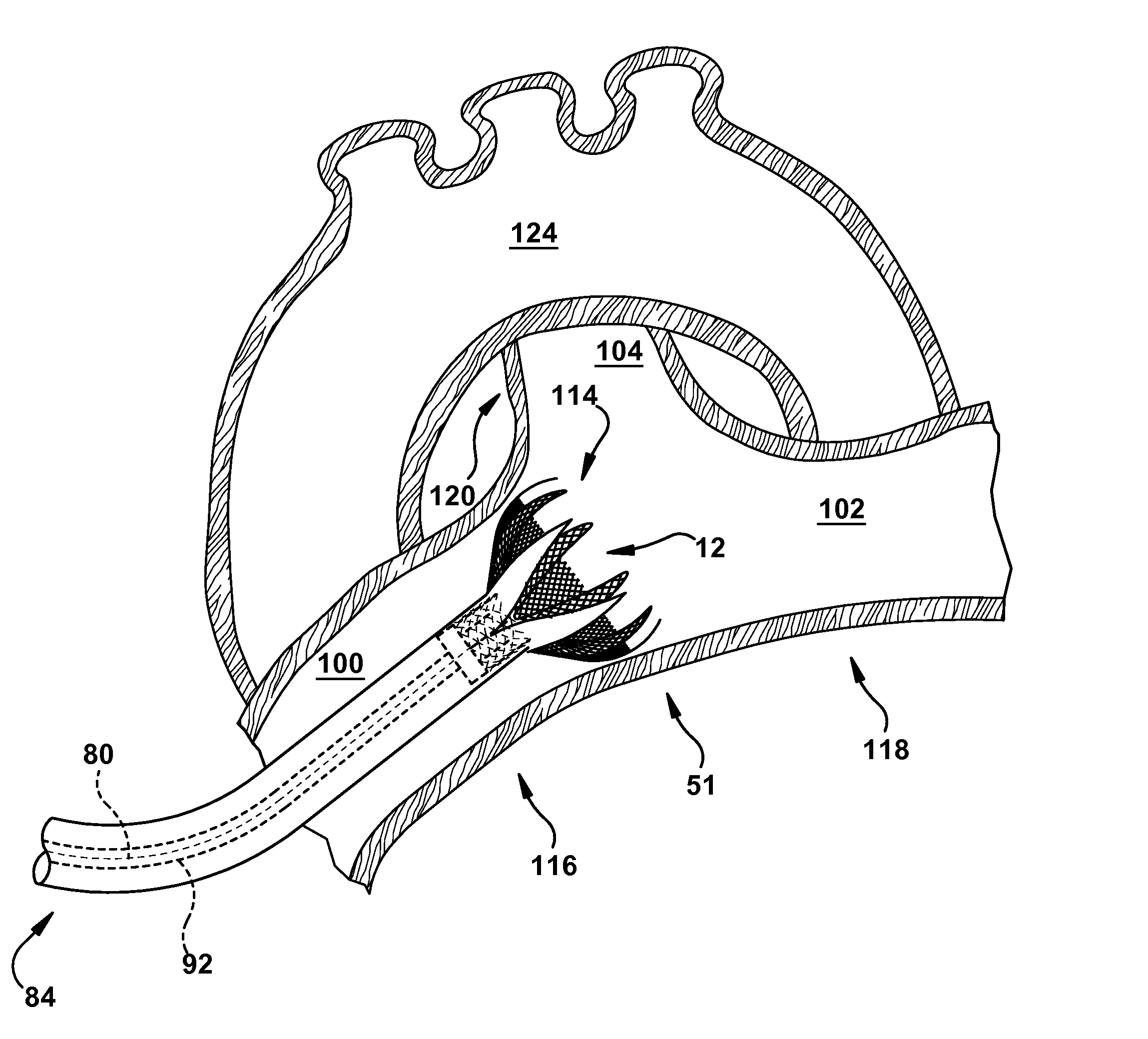 Apparatus and method for treating cardiovascular diseases