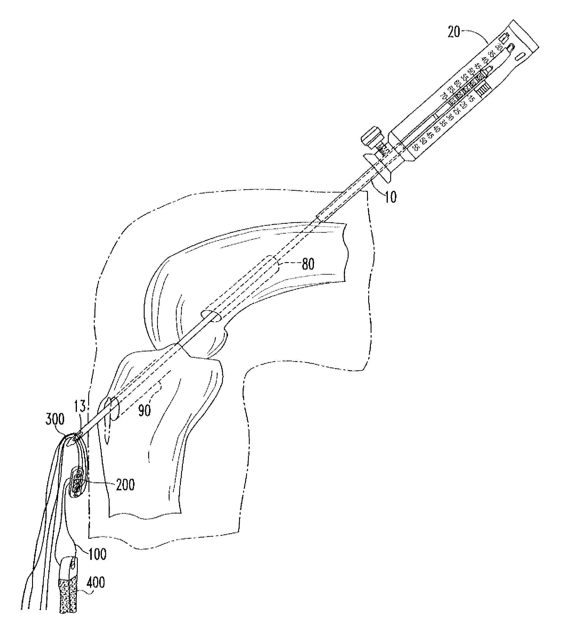 Device and method for use during ligament reconstruction surgery
