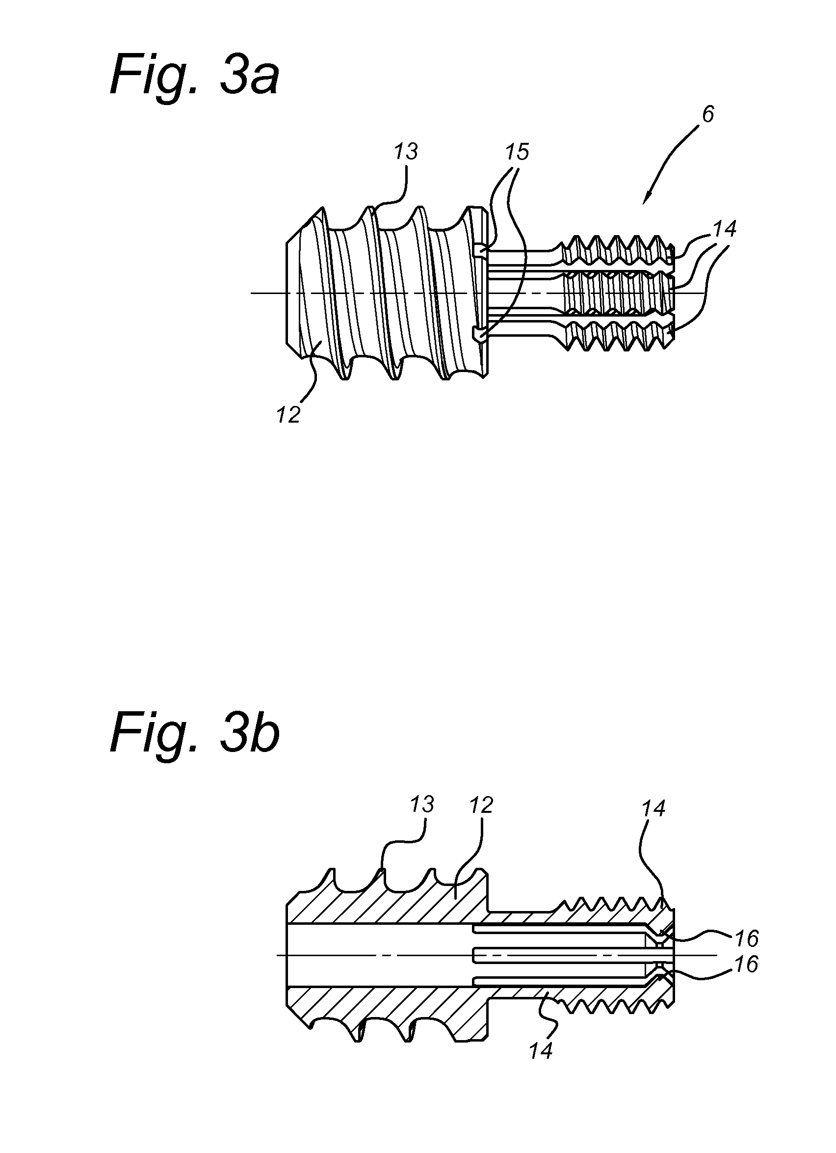 Intramedullary device for mid-shaft clavicle fractures