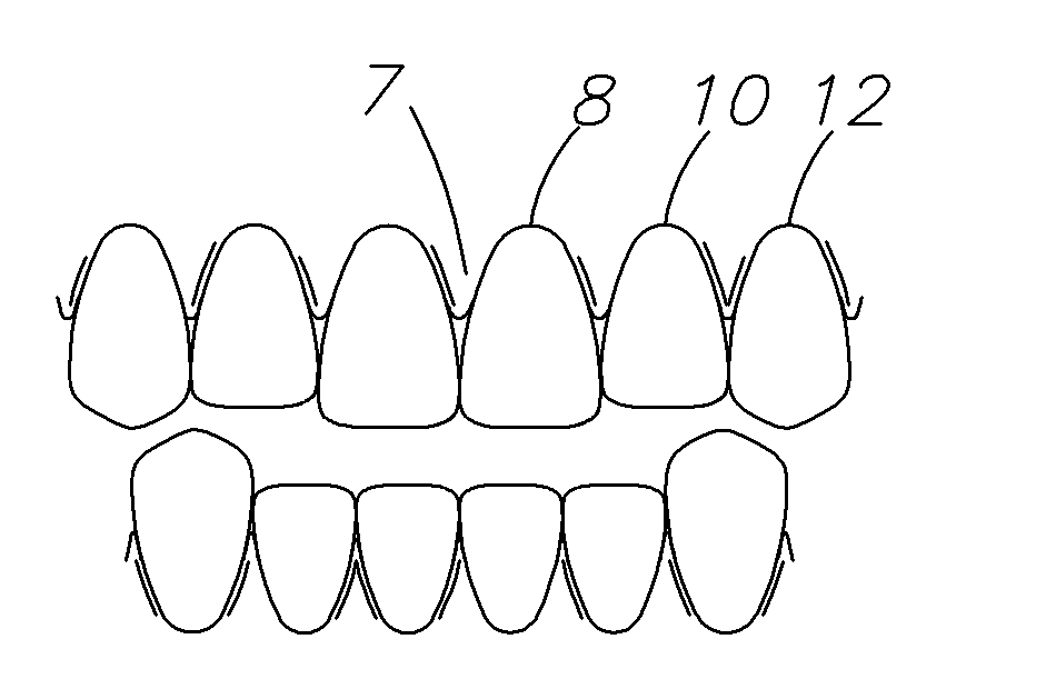 Dental veneer system and method