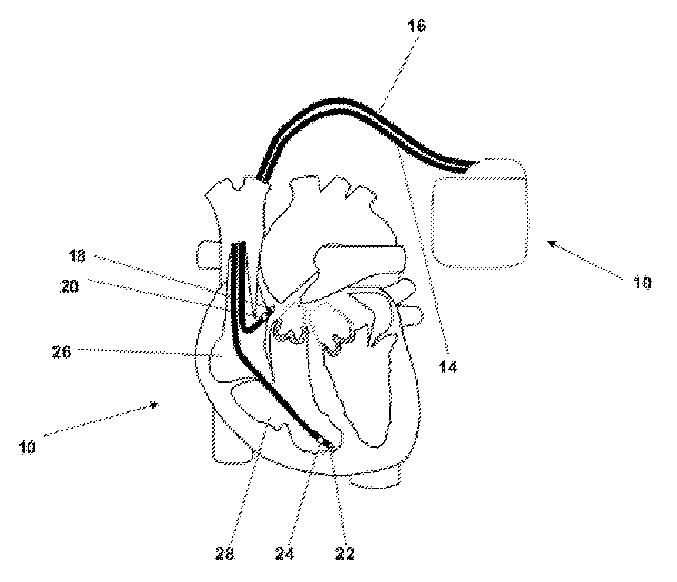 Implantable medical device comprising magnetic field detector