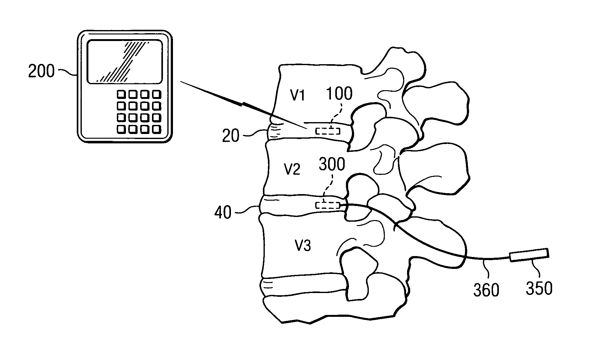 Sensor and method for spinal monitoring