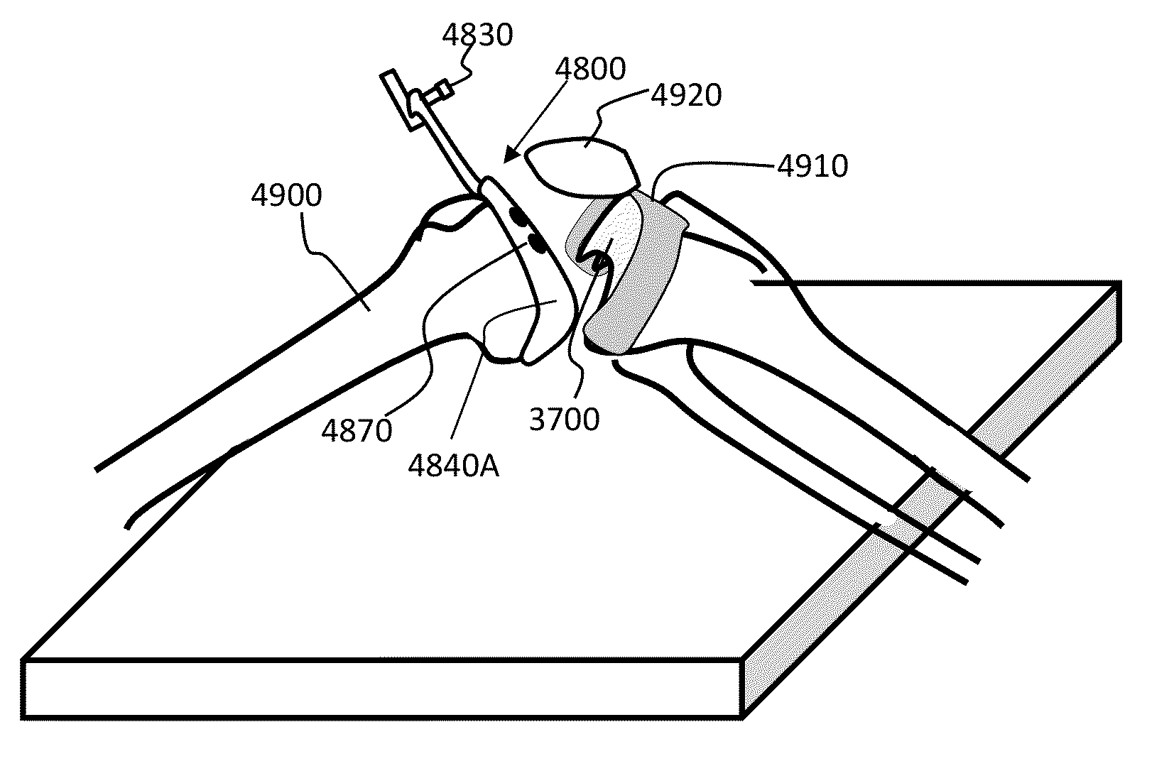 Bone cutting system for alignment relative to a mechanical axis