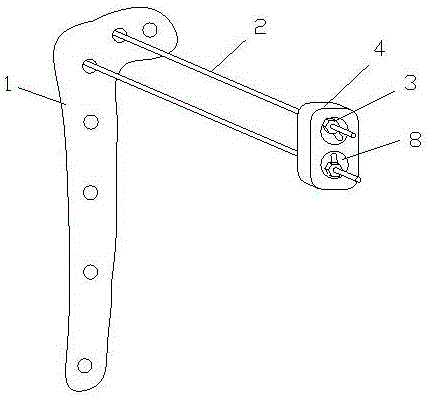 Tibial plateau fracture pressurizing and fixing device