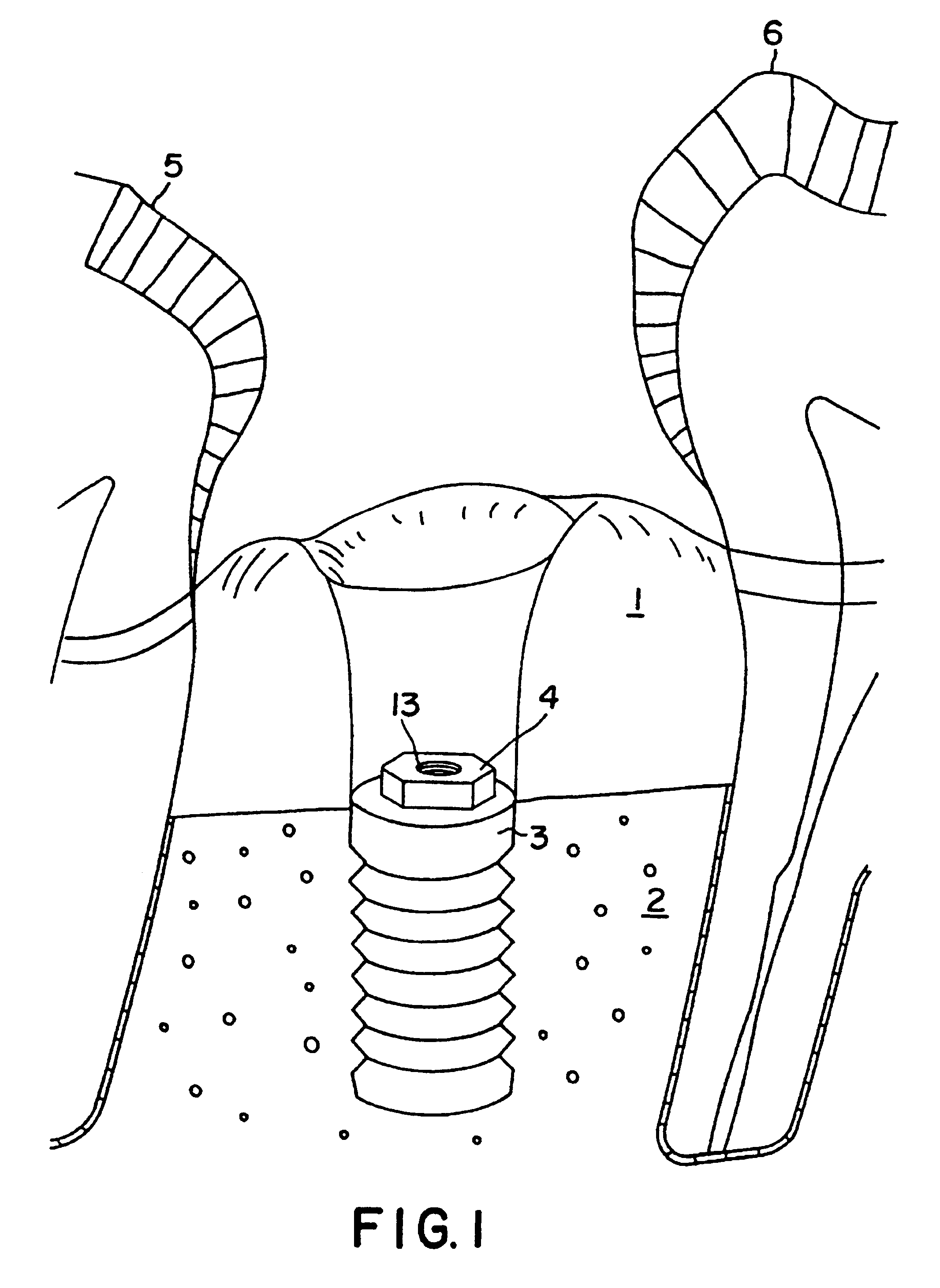 Device for the reconstruction of teeth