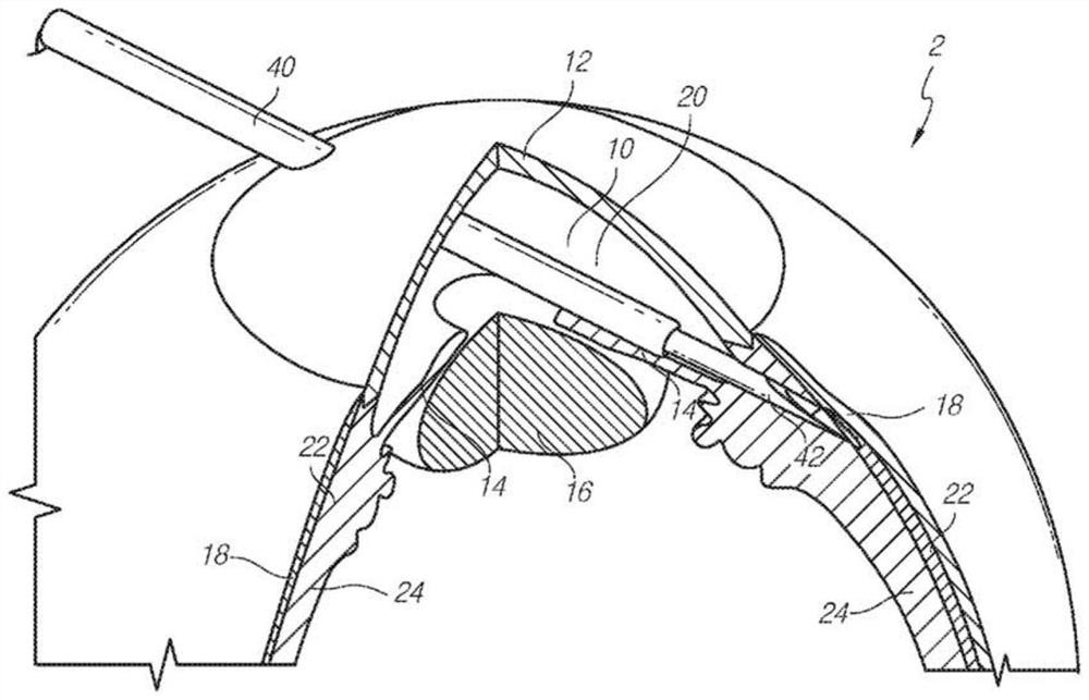 Manually adjustable intraocular flow adjustment