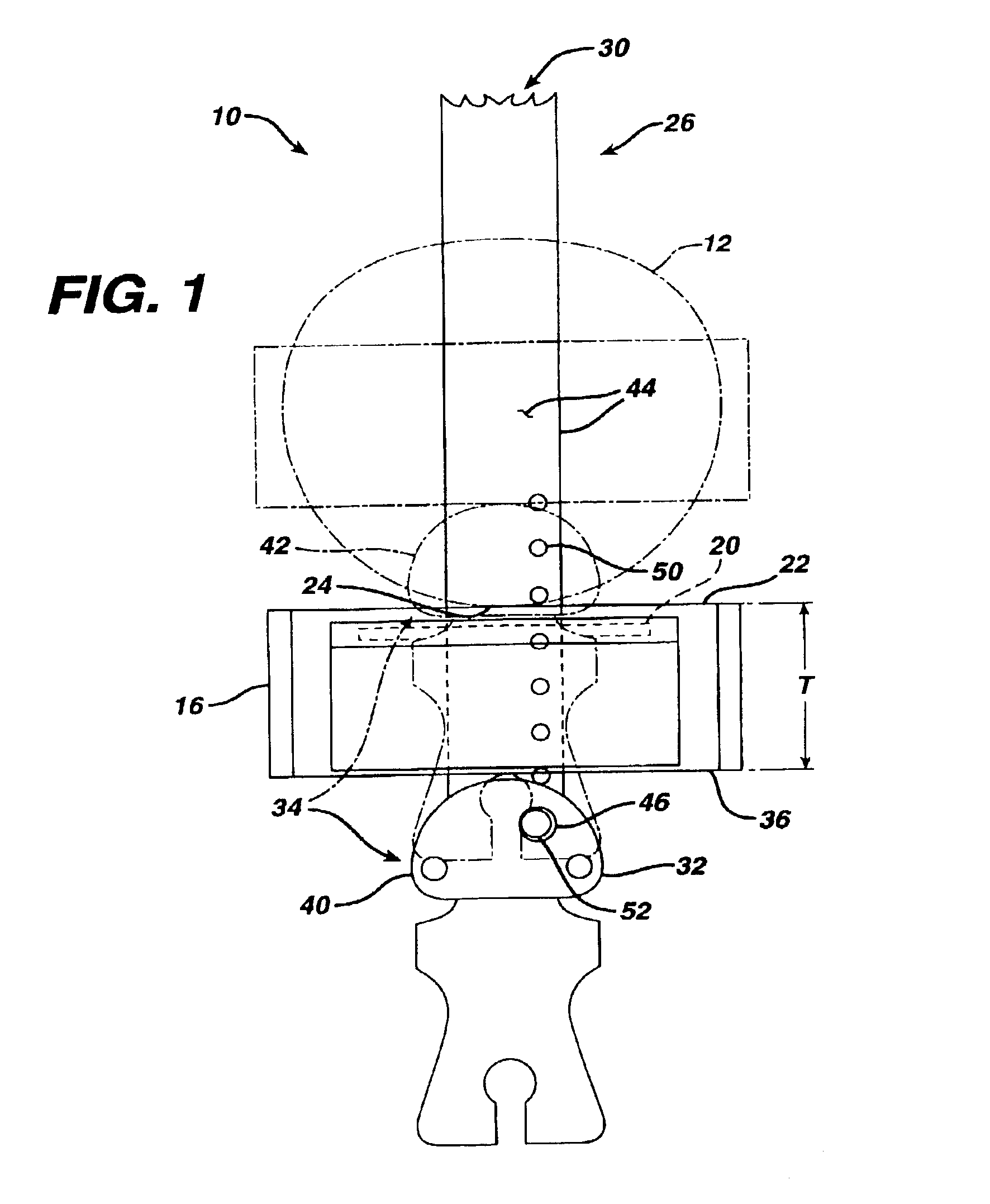 Blade for resection of bone for prosthesis implantation, blade stop and method