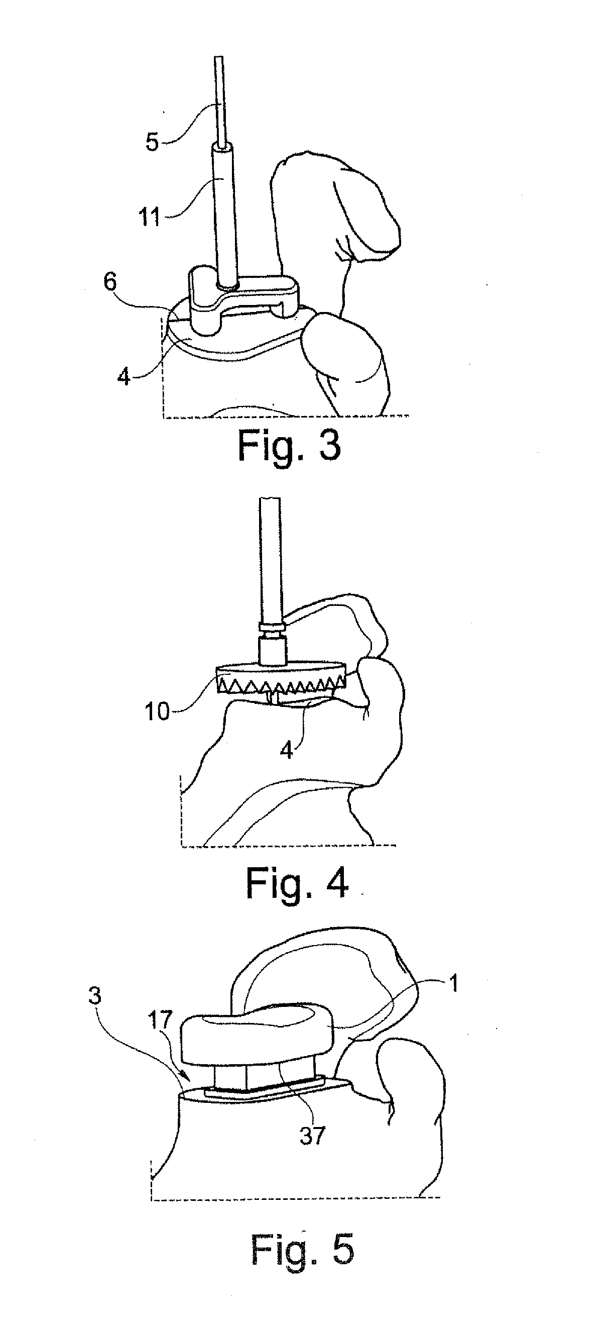 Allogenic Articular Cavity Prosthesis and Method for Implanting the Same